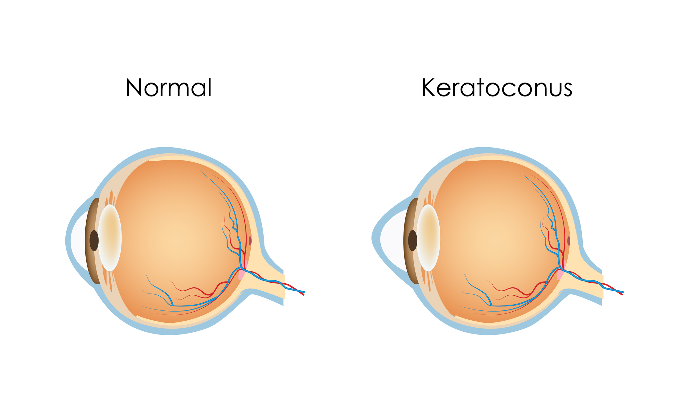 Keratoconus: A Guide to Symptoms, Causes, and Care