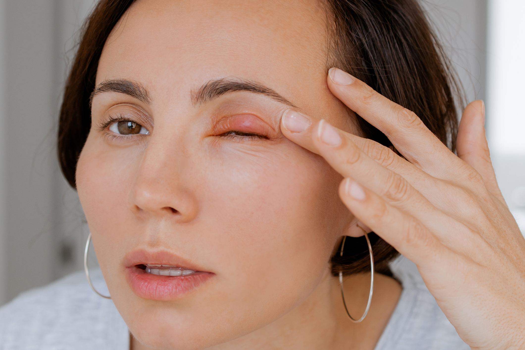 Overview of Ectropion: Understanding Outward-Turning Eyelids