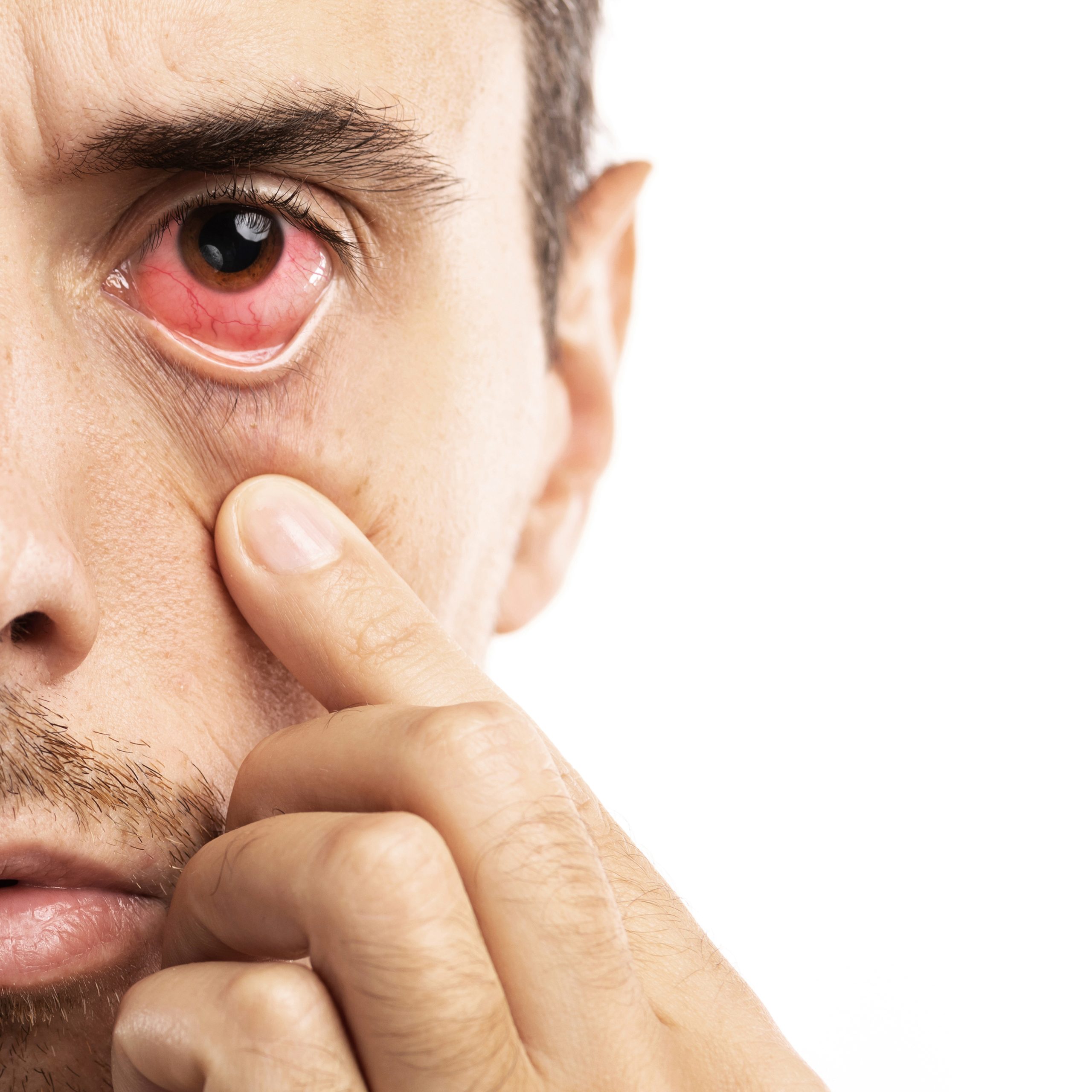 Subconjunctival Hemorrhage (Eye Bleeding)