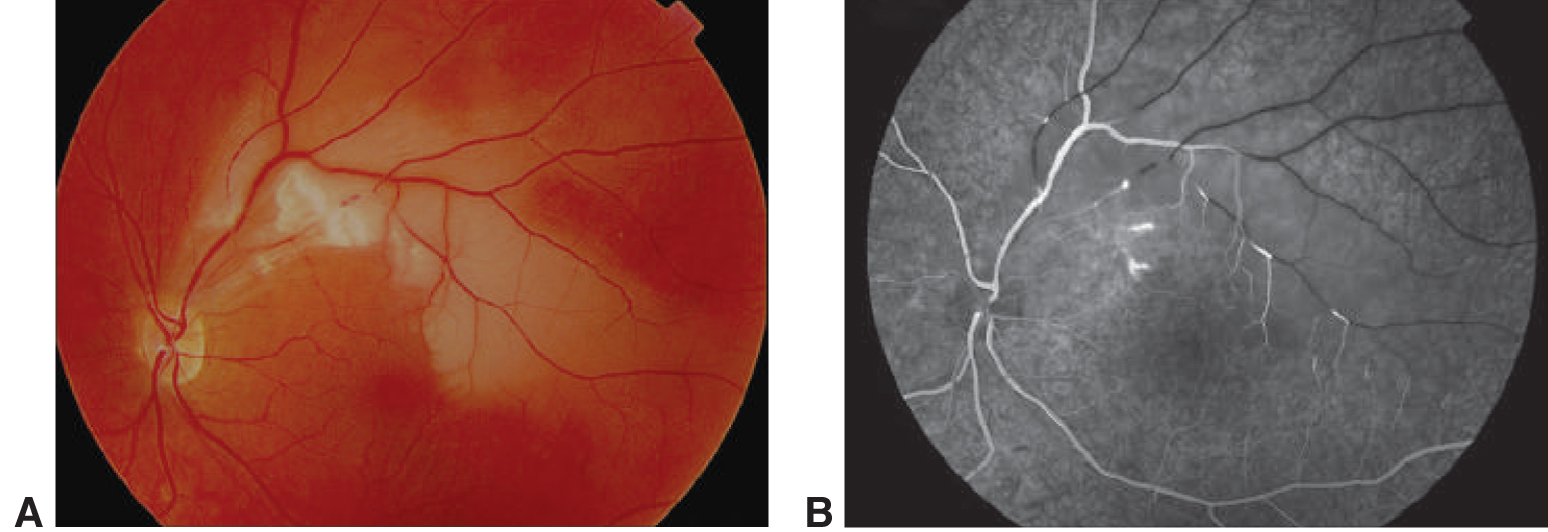 What You Need to Know About Susac Syndrome