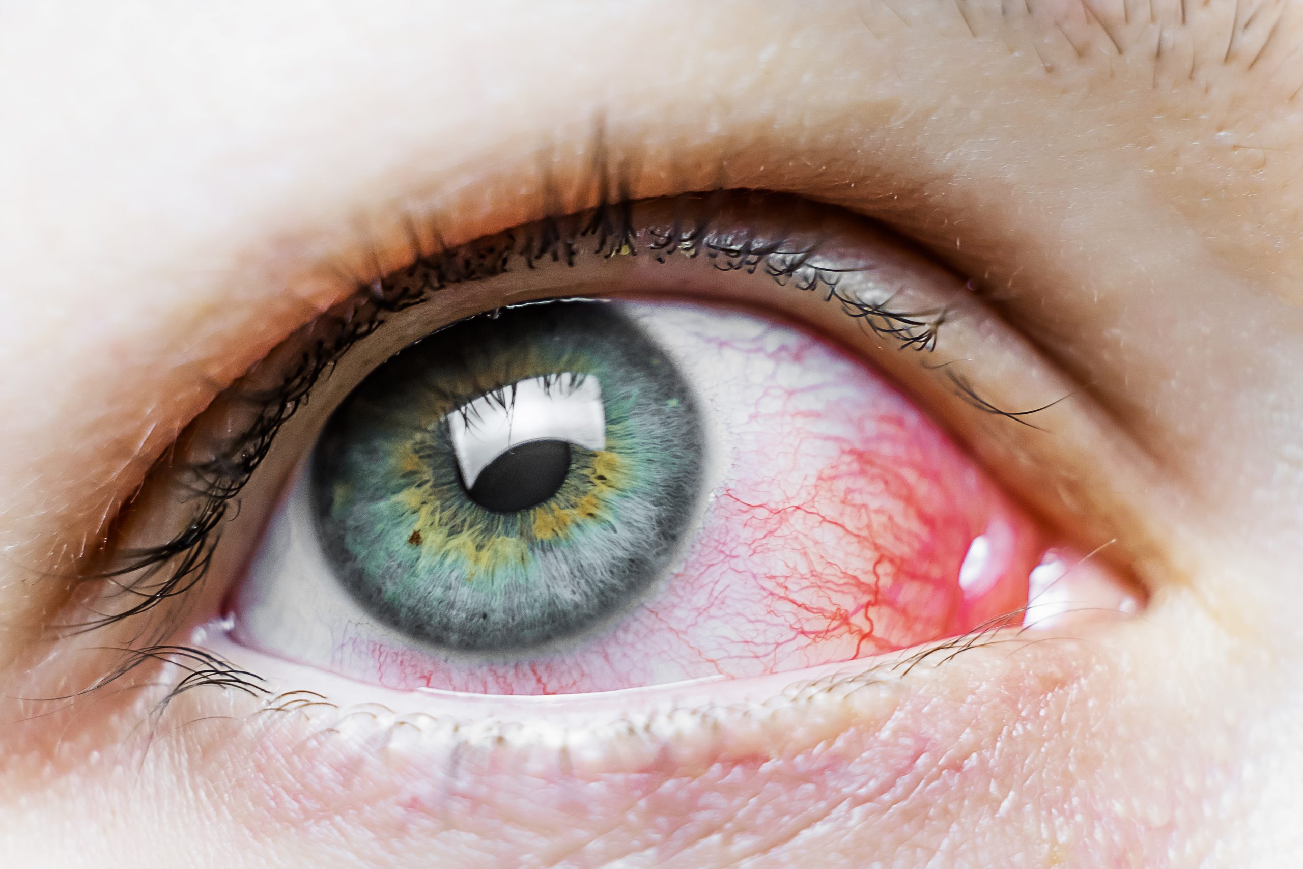 Navigating the Causes and Symptoms of Pink Eye