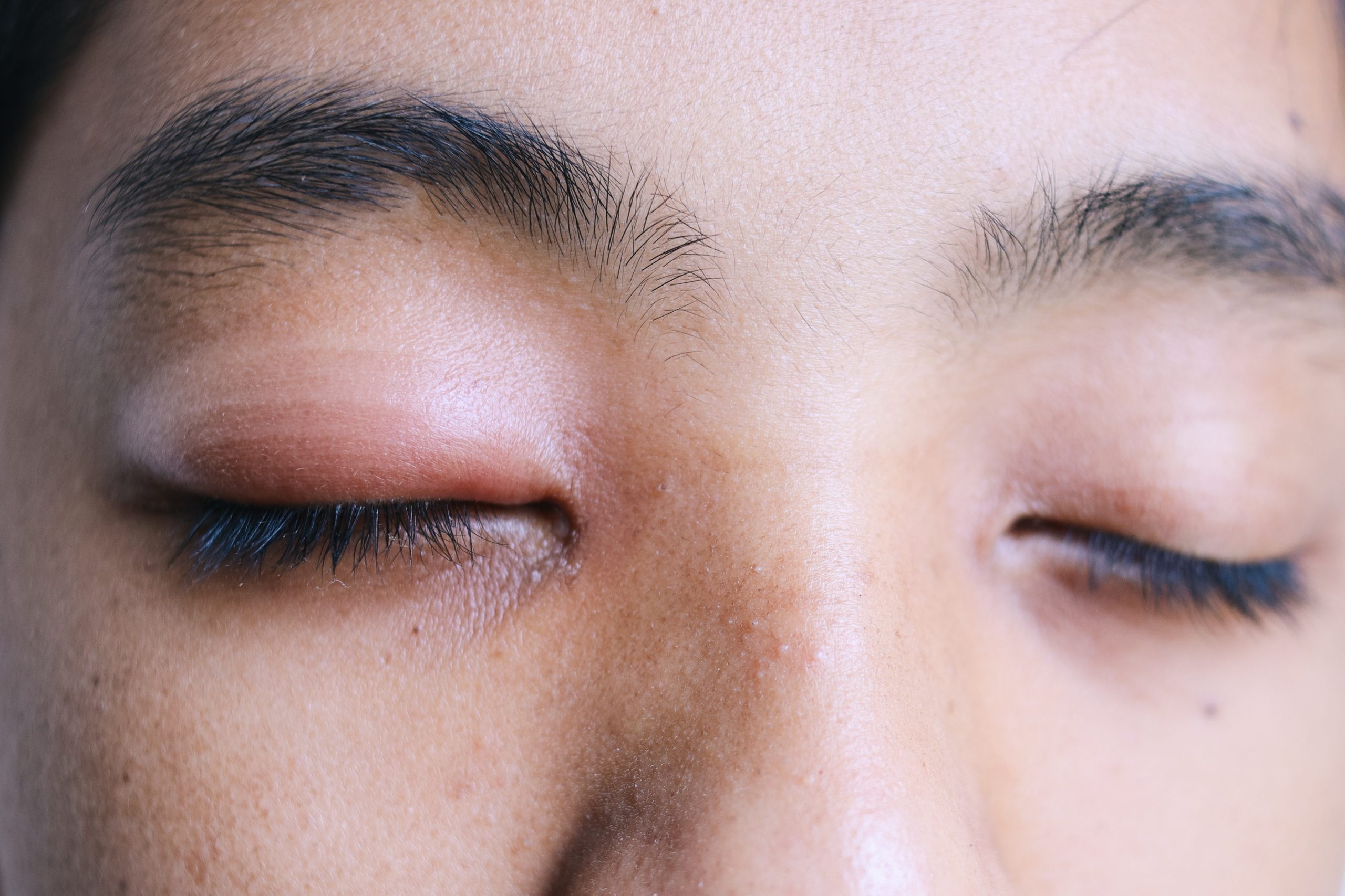 A Closer Look at Internal Styes: Causes, Diagnosis, and Relief