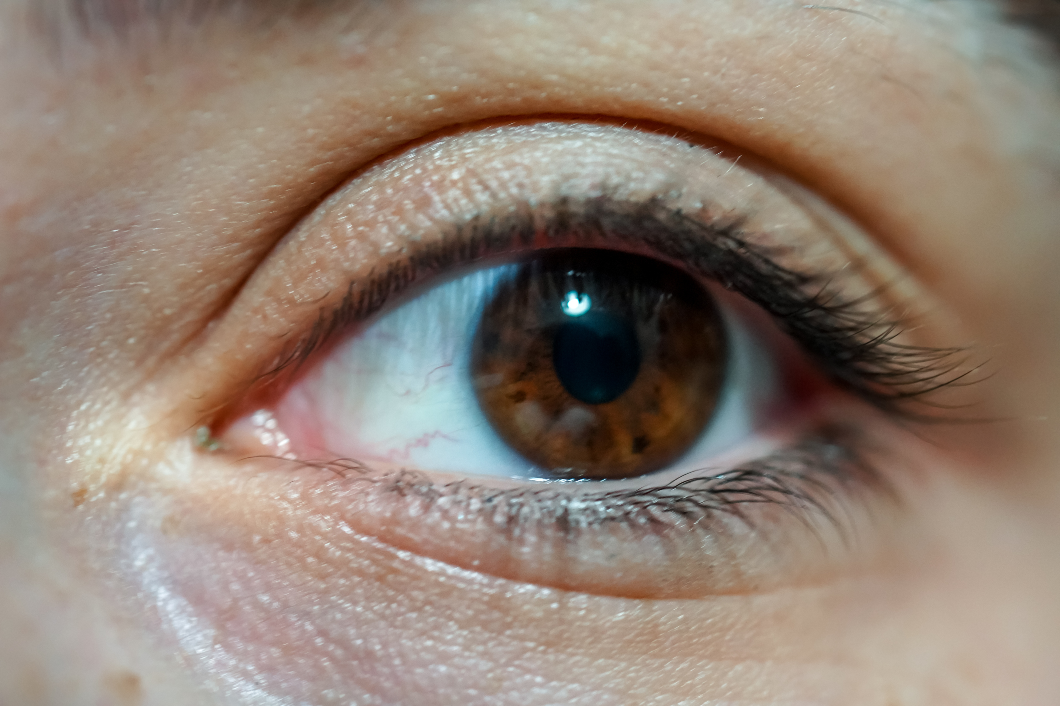 A Closer Look at Corneal Edema