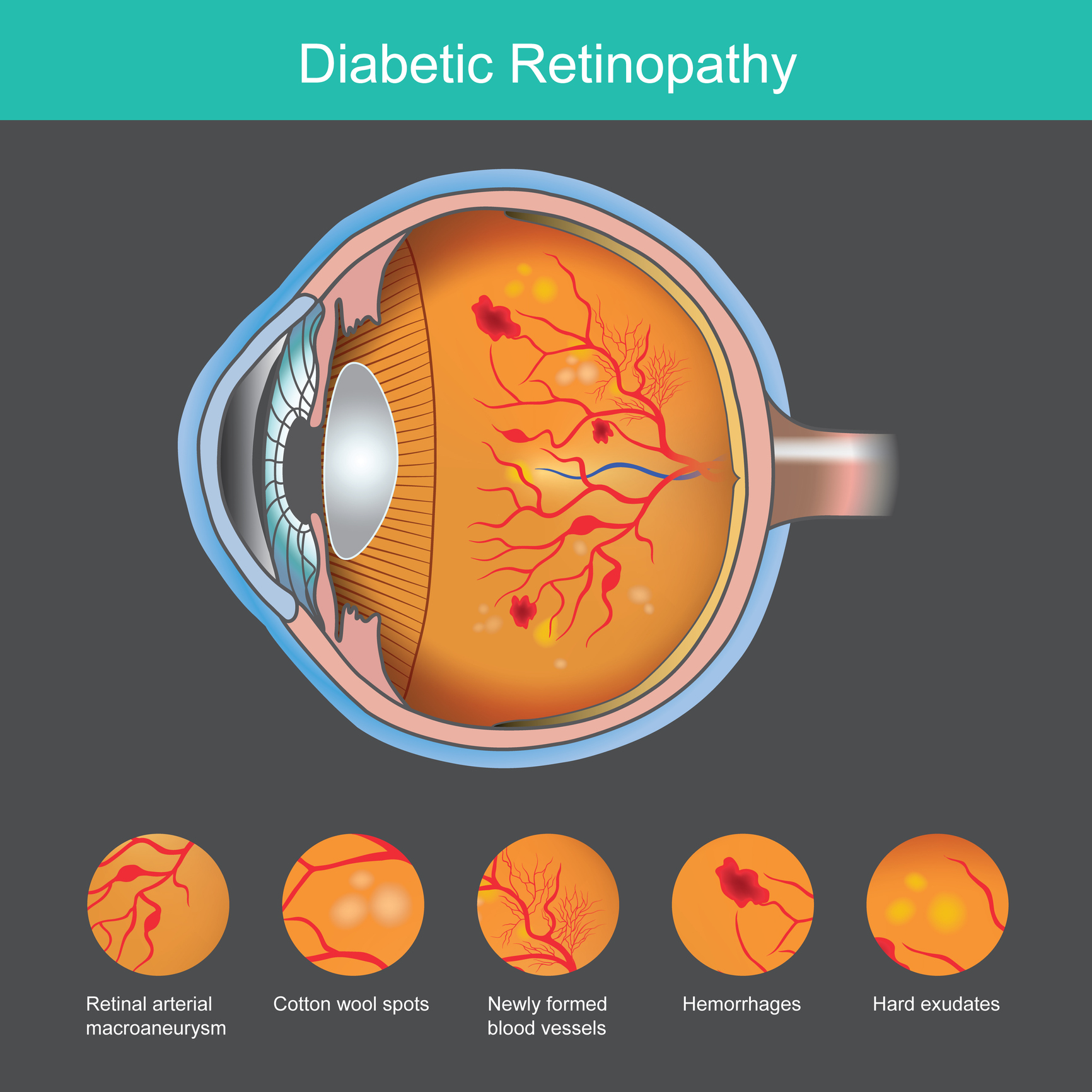 Managing Cytomegalovirus Retinitis