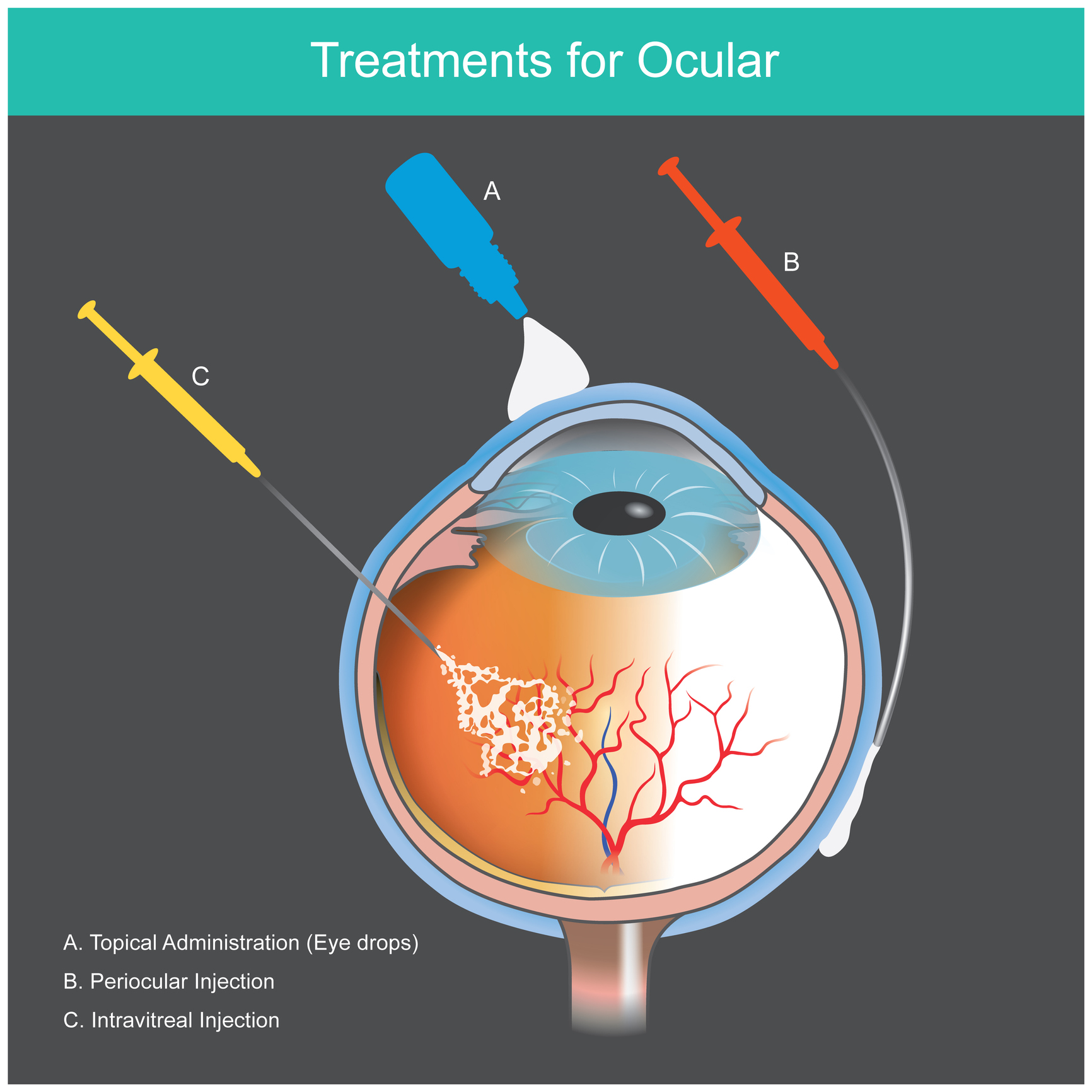 Exotropia: A Comprehensive Overview