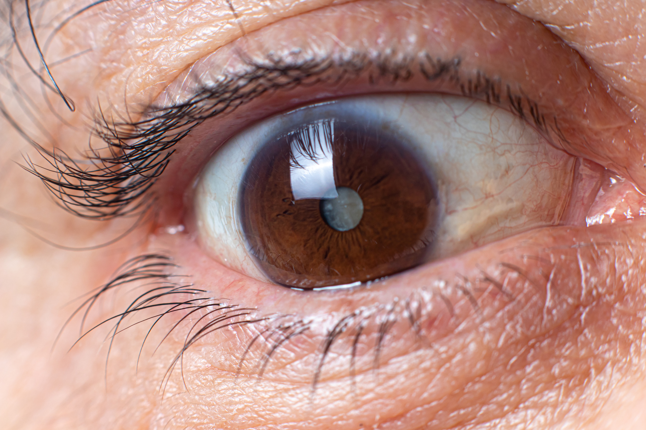 Eye Disorder,Ocular Condition Angioid Streaks Unveiled: Causes, Symptoms, And Management