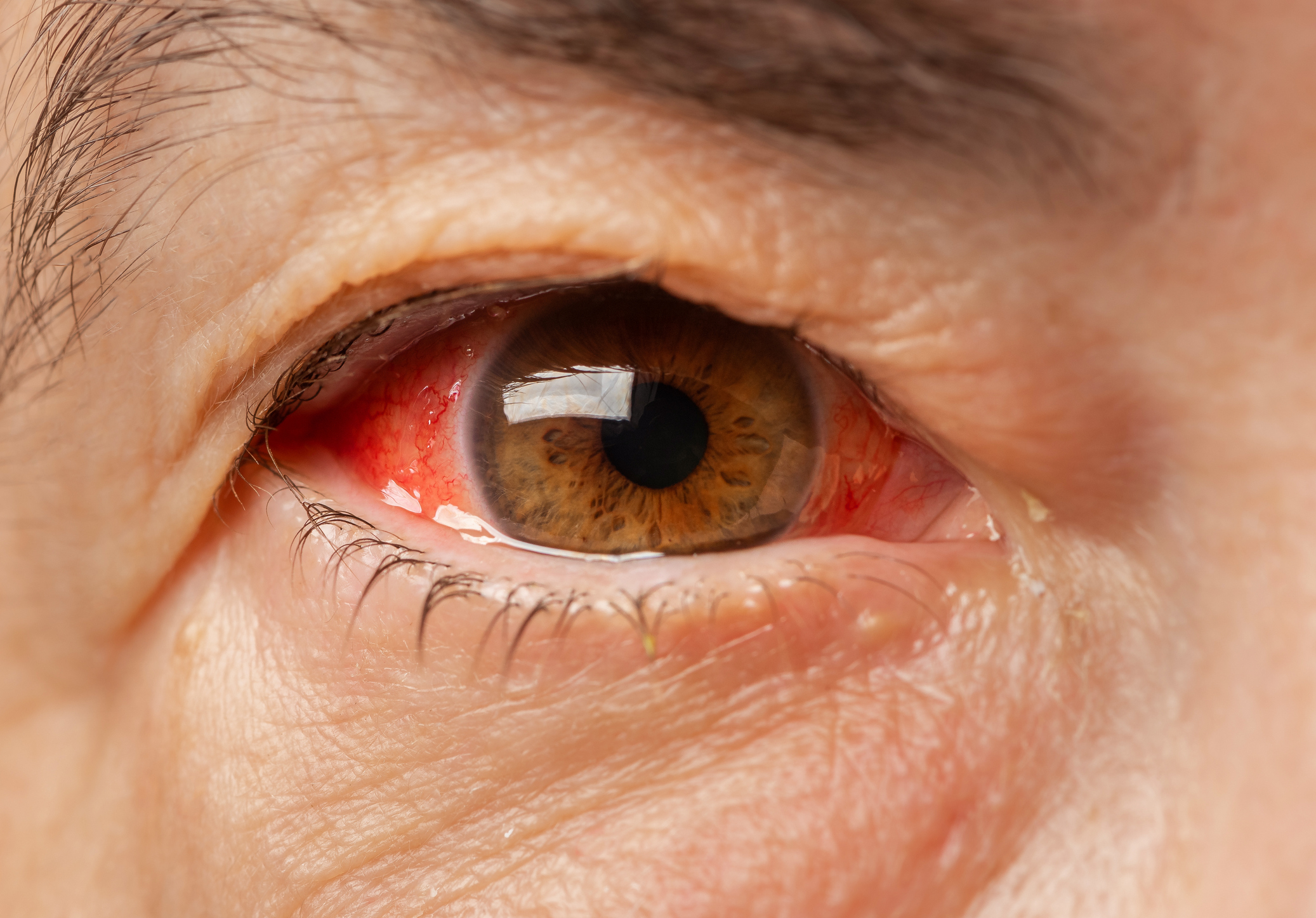 Hyphema: Navigating the Red Waters of Eye Injury