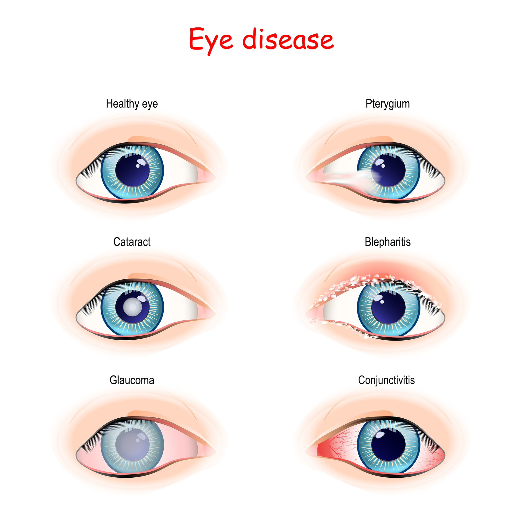 Horner Syndrome | Comprehensive Eye Care Guide