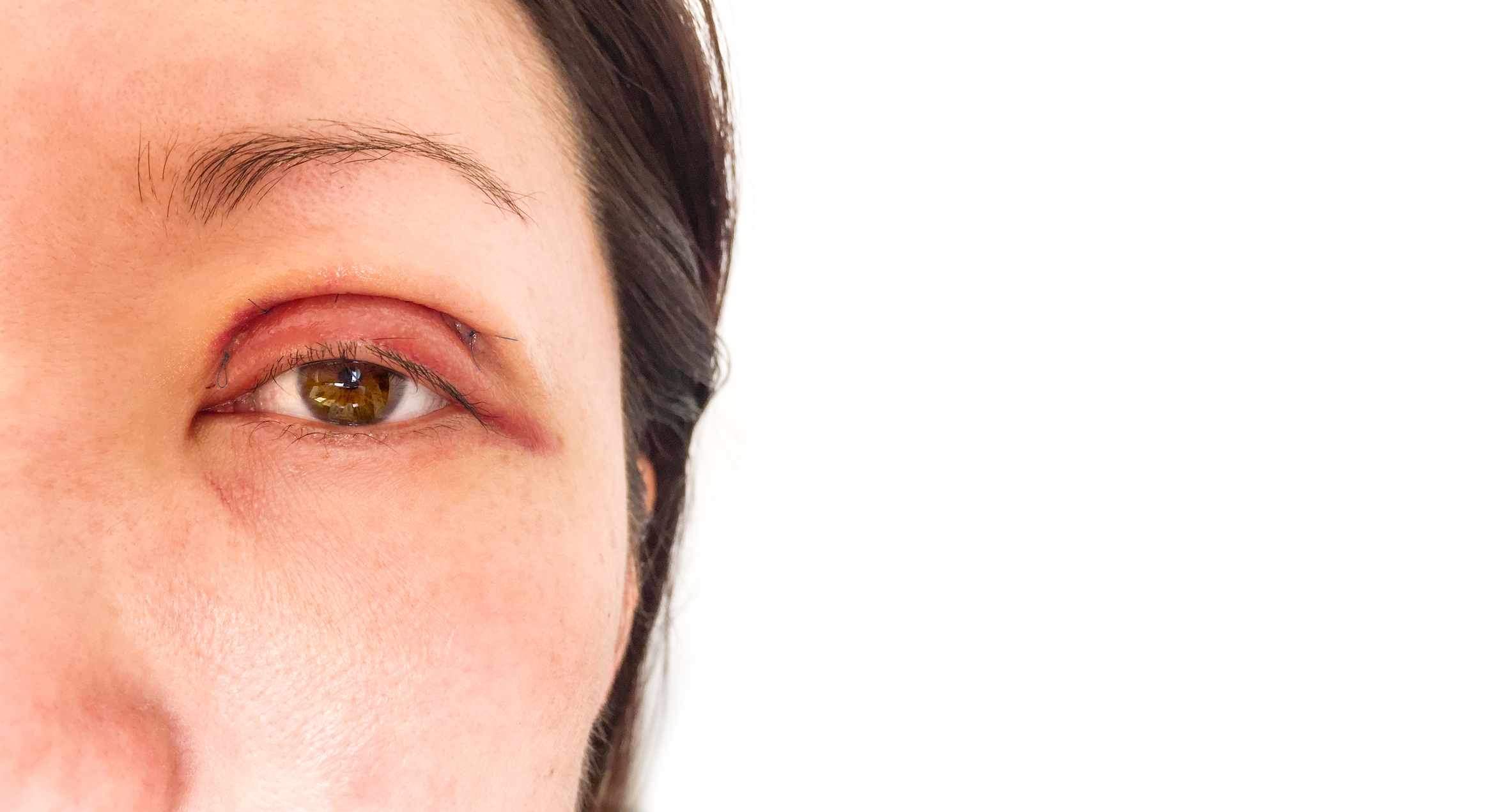Eyelid Dermatitis: Understanding Types, Causes, and Care