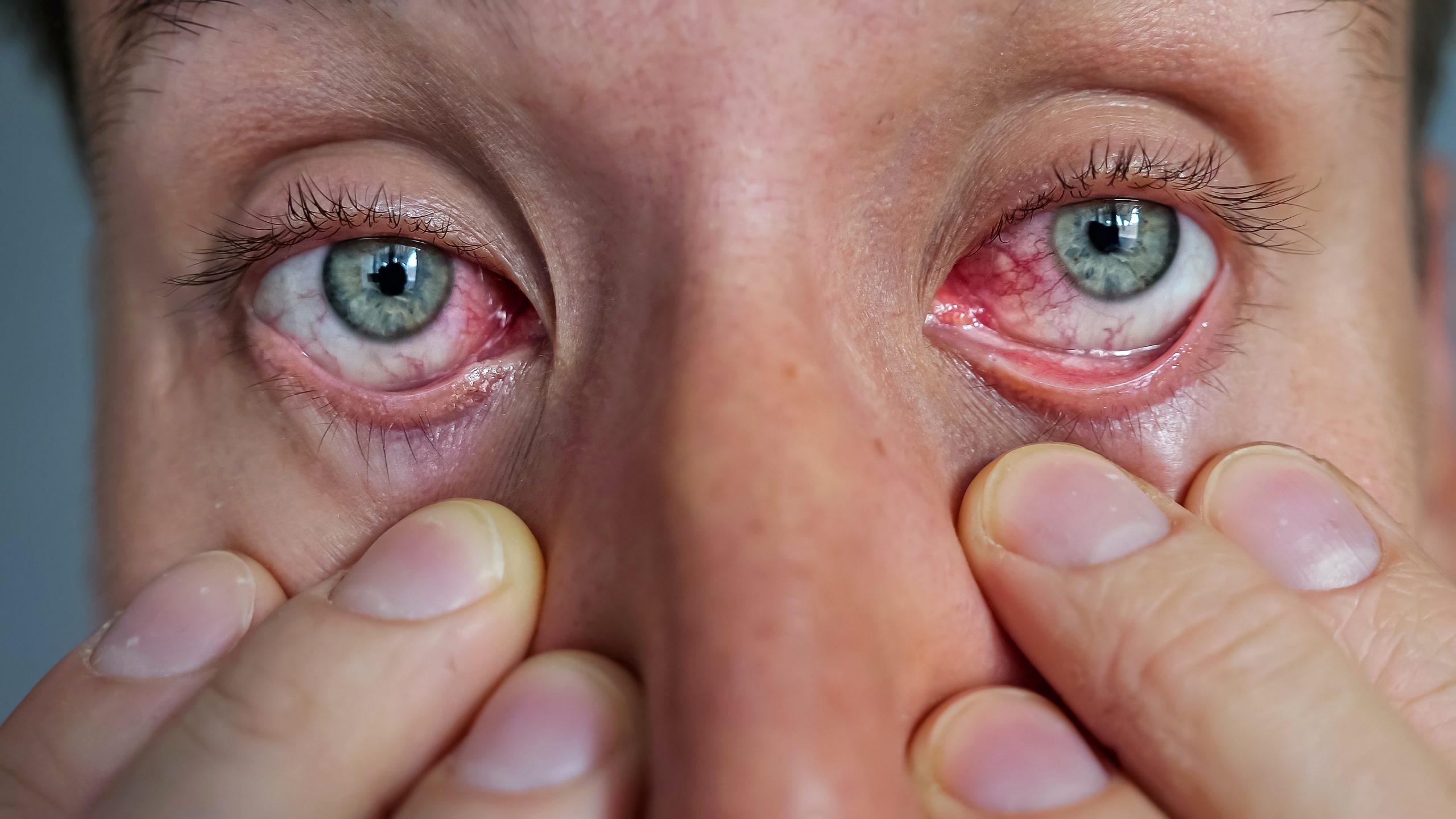 Psoriasis on the Eyelids: Understanding the Condition