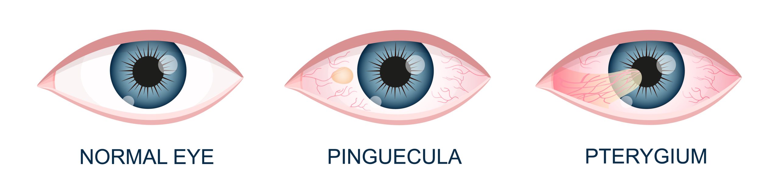 Pinguecula Uncovered: Causes, Symptoms