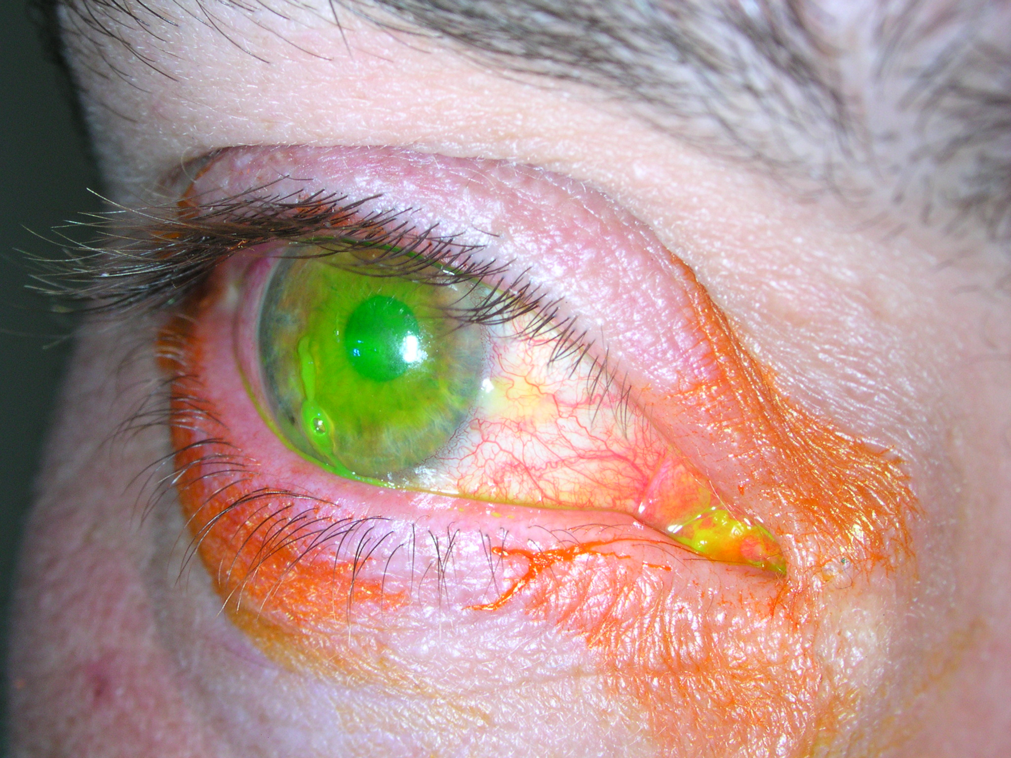 Managing Chemical Burns in the Eye