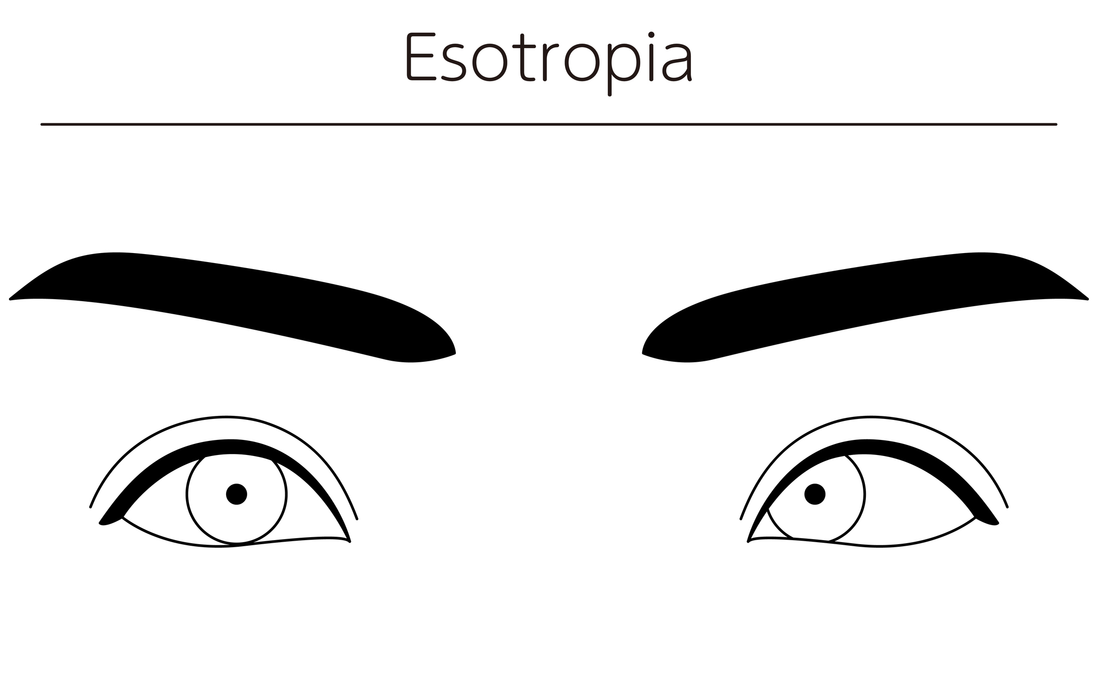 Living With Esotropia: Strategies For Coping And Treatment