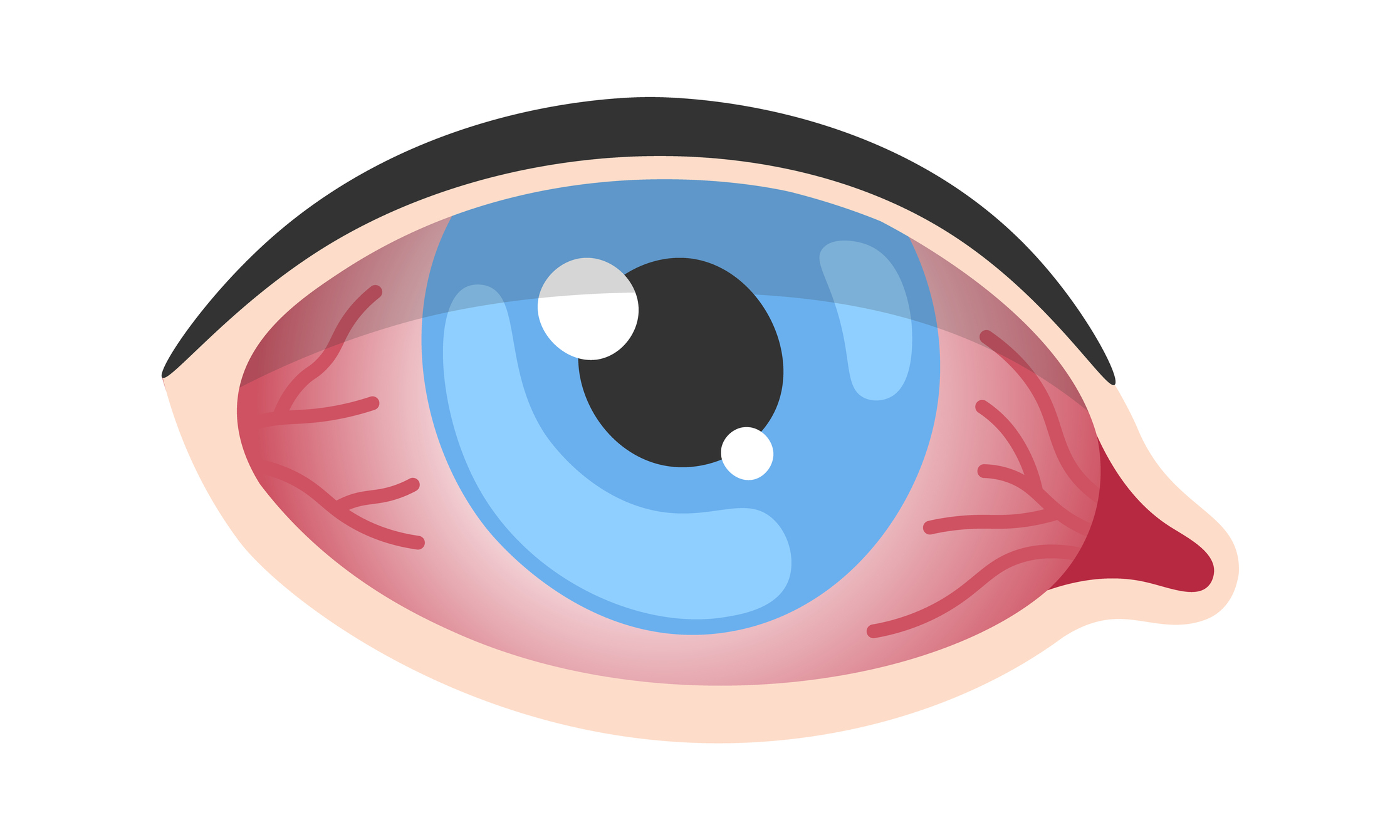 Ocular Synechiae: Causes, Symptoms, Treatment - World Eye Care Foundation