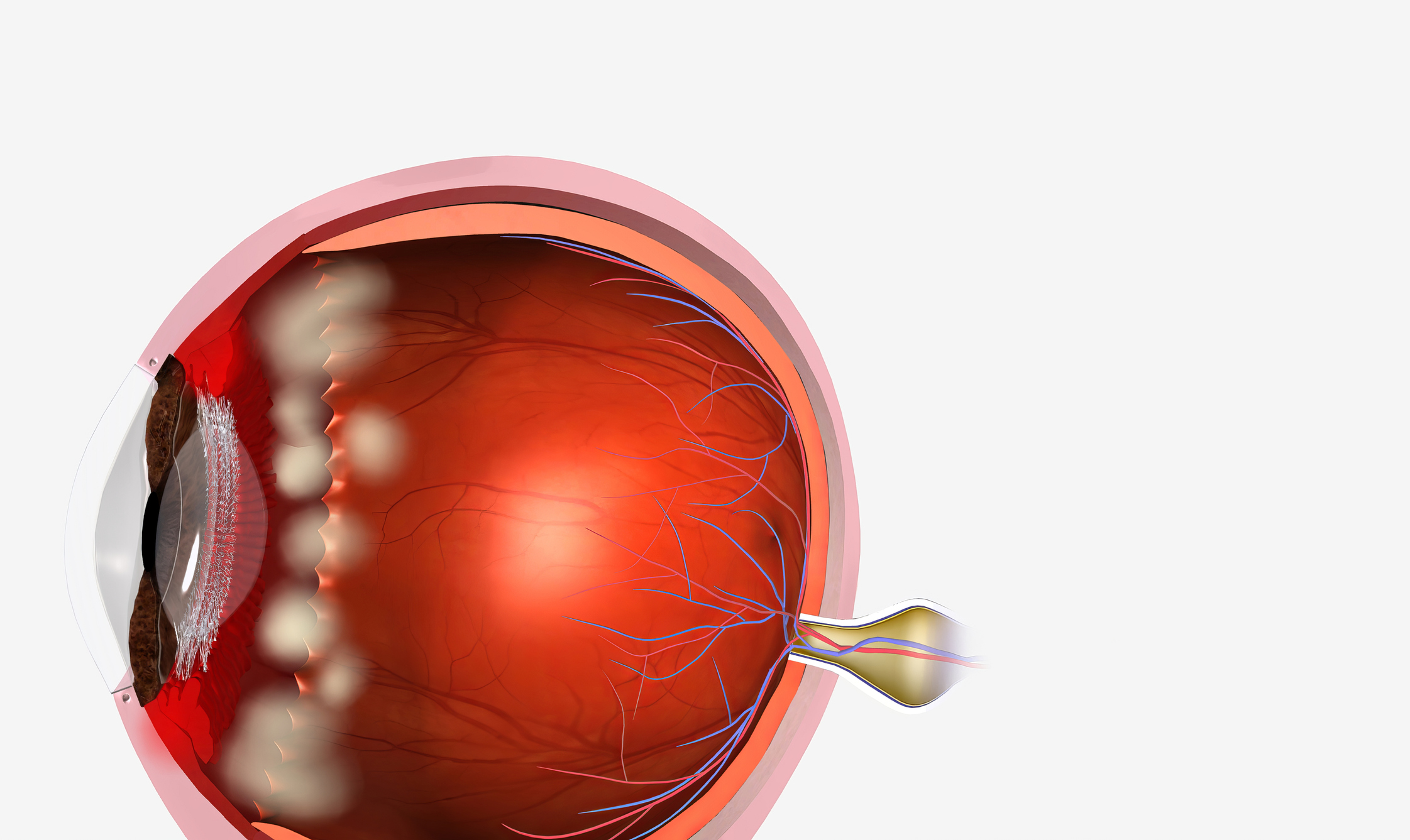 Overview of Loiasis: Understanding the Eye Worm Disease