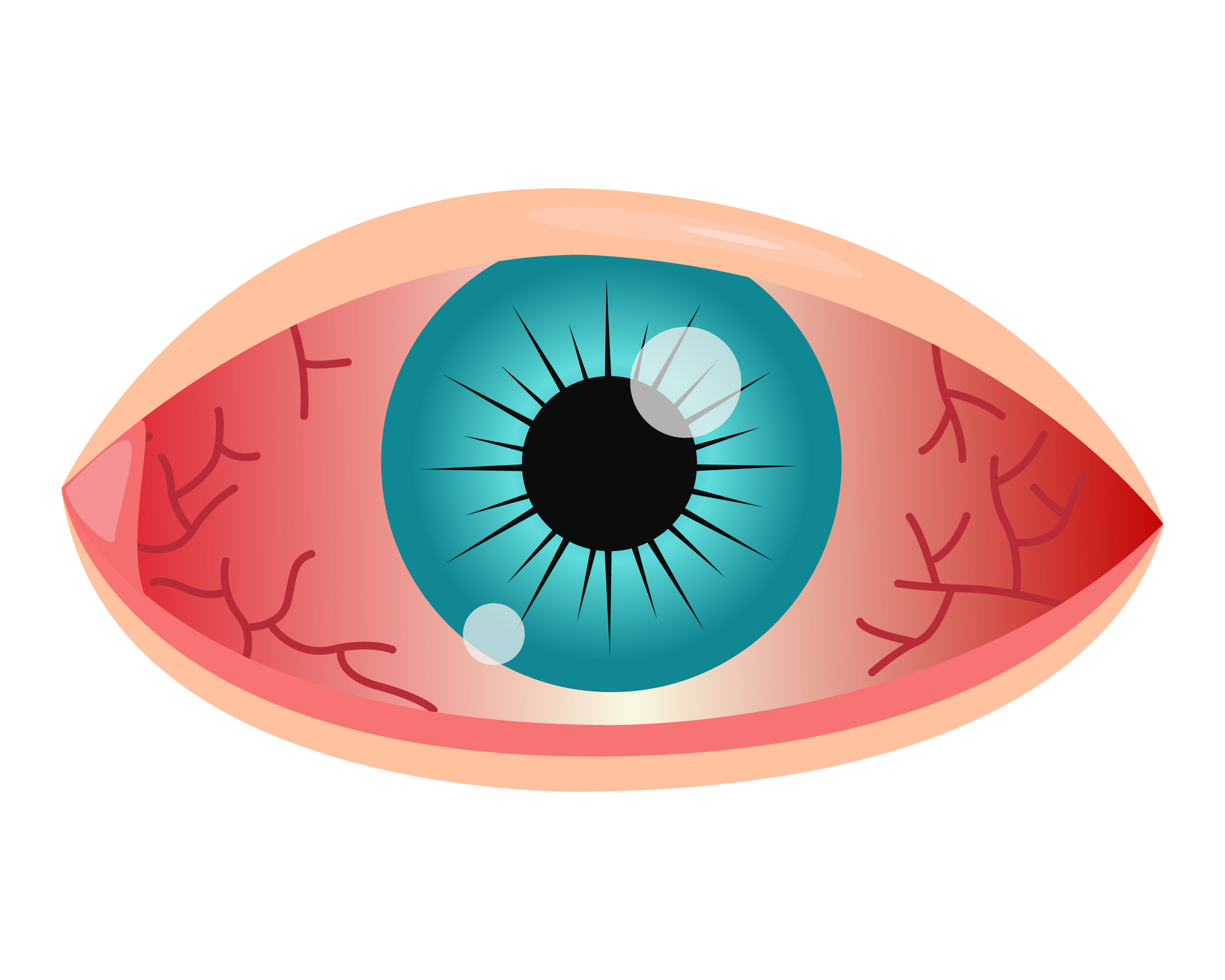 Corneal Ulcers: Causes, Symptoms, and Timely Treatment