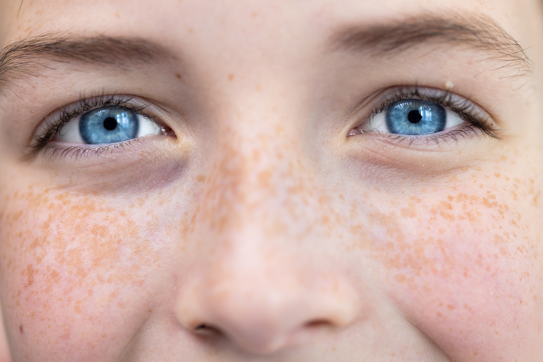 Understanding Eye Freckles and Nevi: A Comprehensive Guide