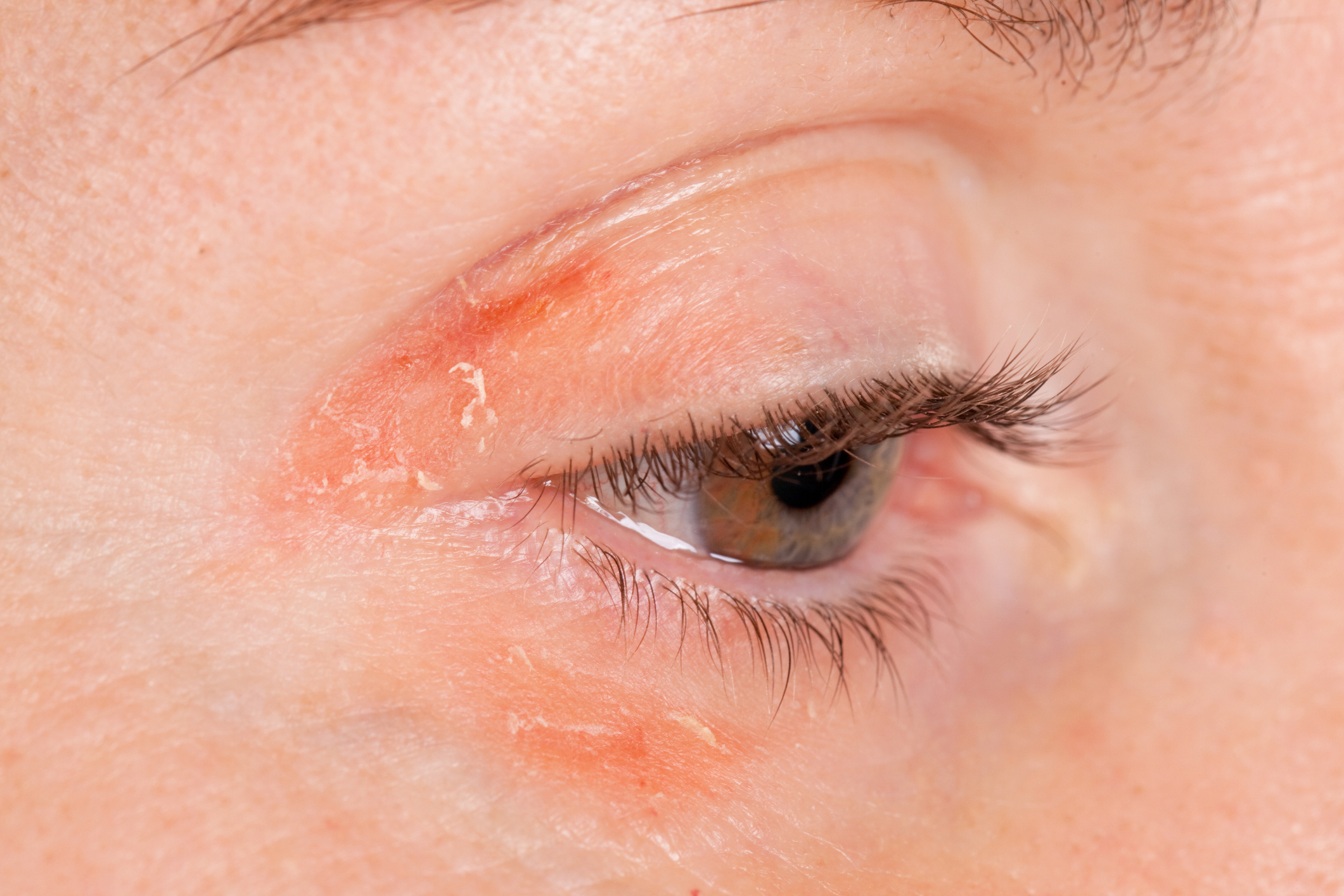 Preventing And Managing Corneal Flash Burns