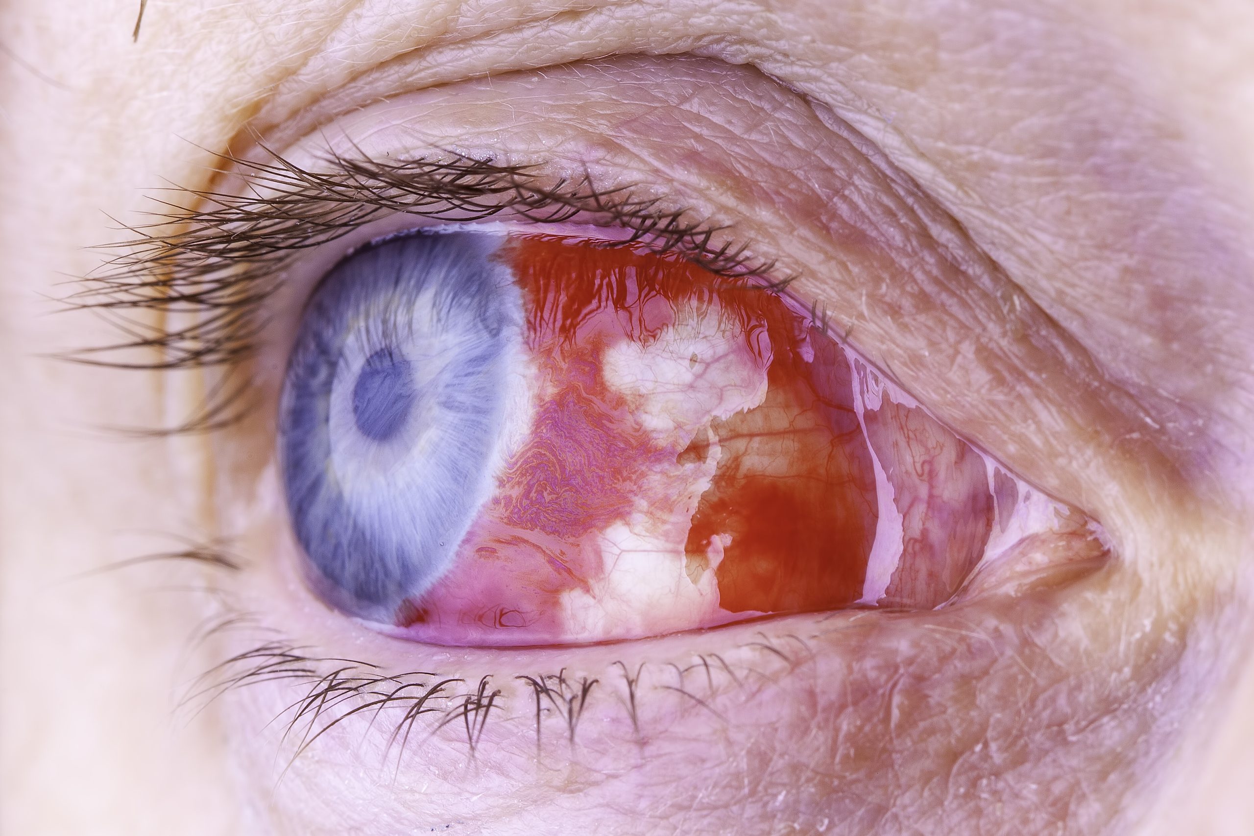 Navigating Life With Uveitis And Inflammatory Eye Conditions