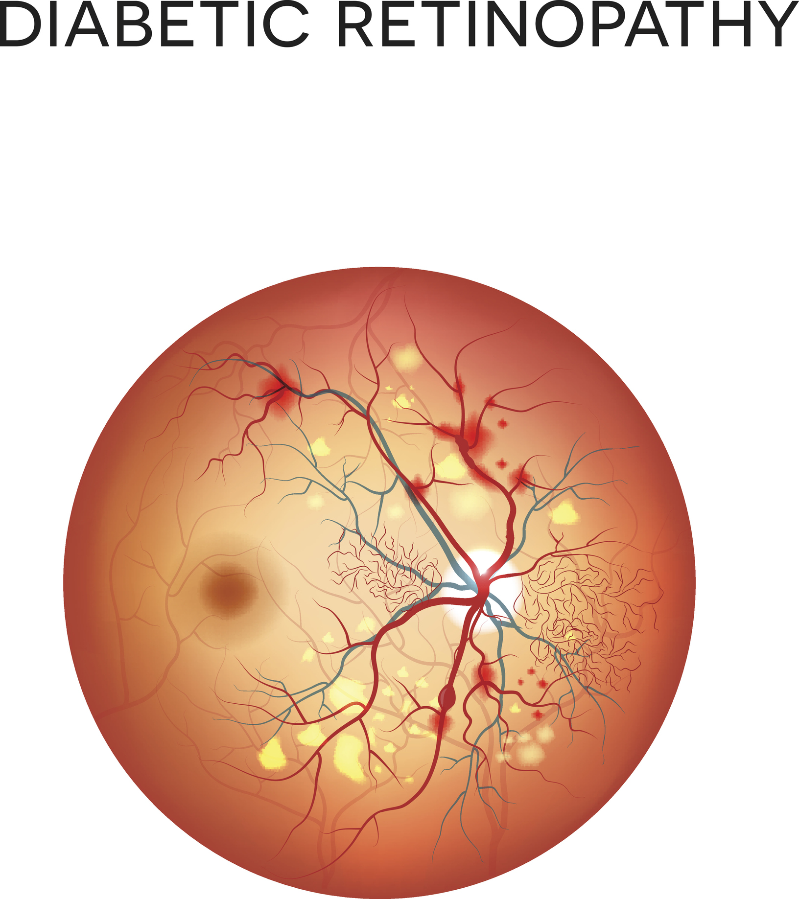 Understanding Hypertensive Retinopathy