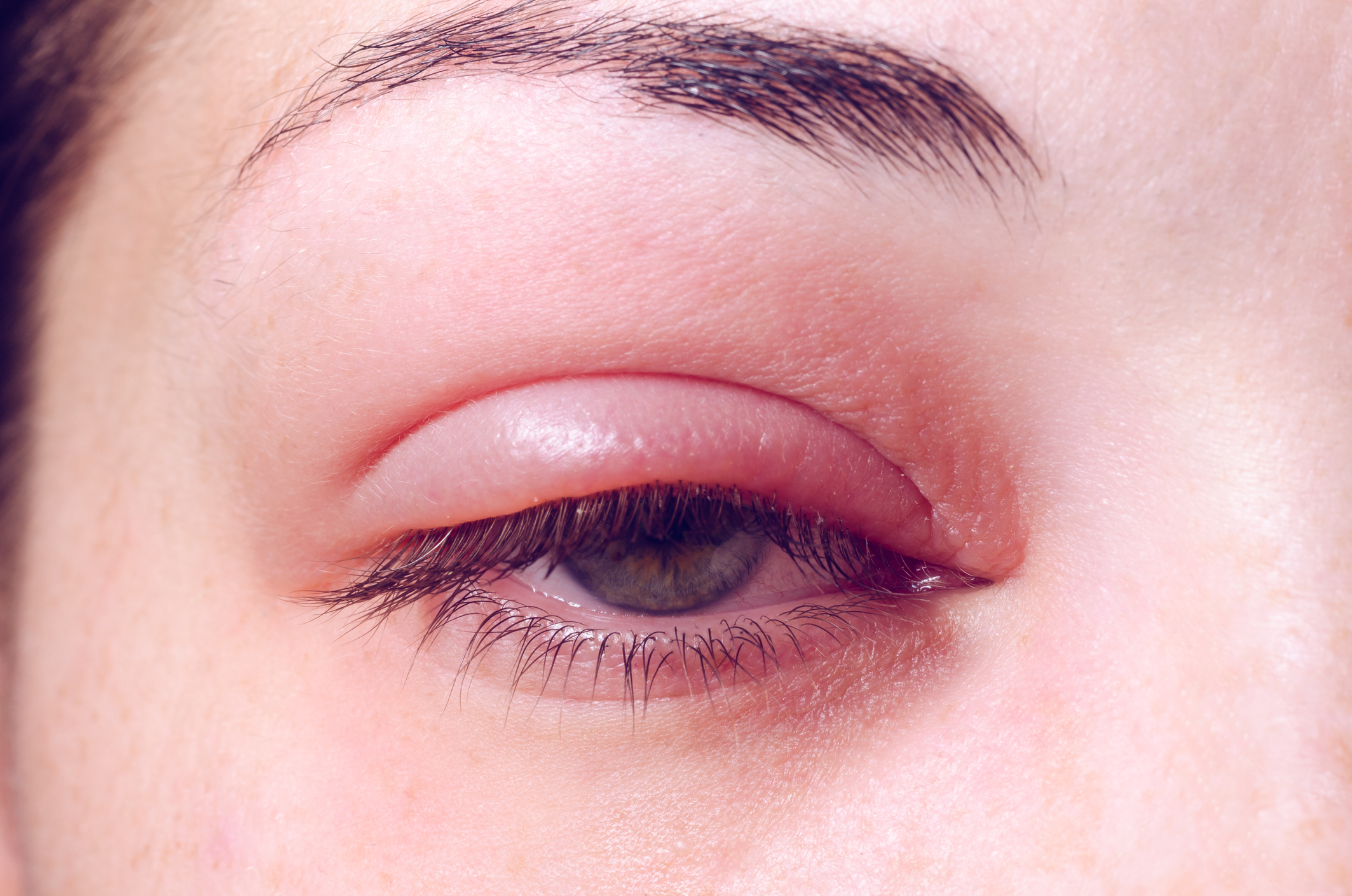Inflammation at the Lid: Understanding the Dynamics of Blepharitis