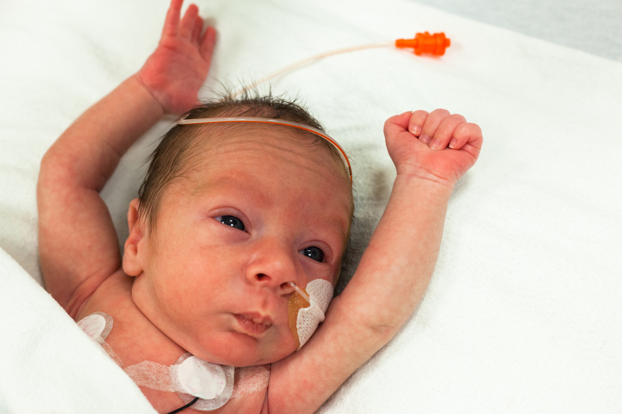 Retinopathy of Prematurity: A Critical Look at Neonatal Eye Health