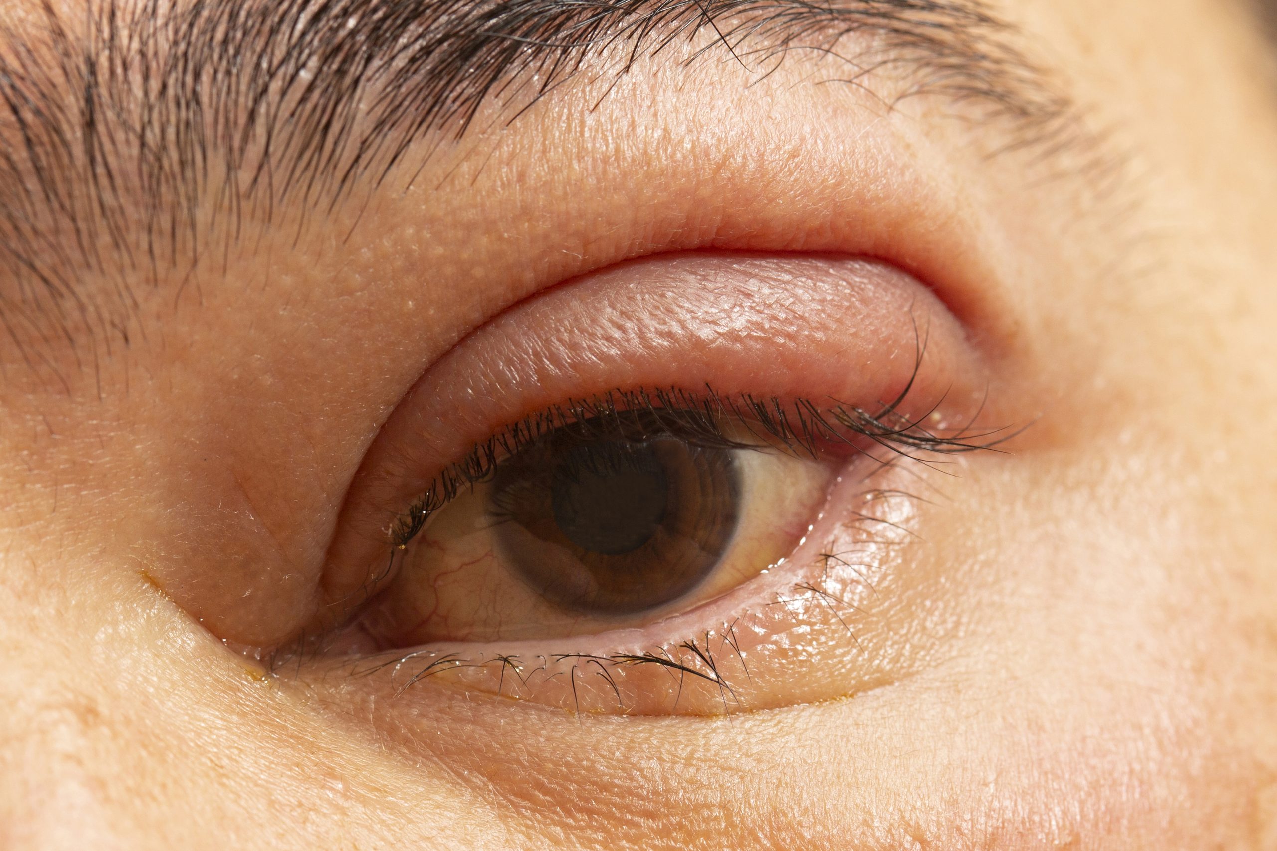 Stye: What You Need to Know About Causes, Symptoms