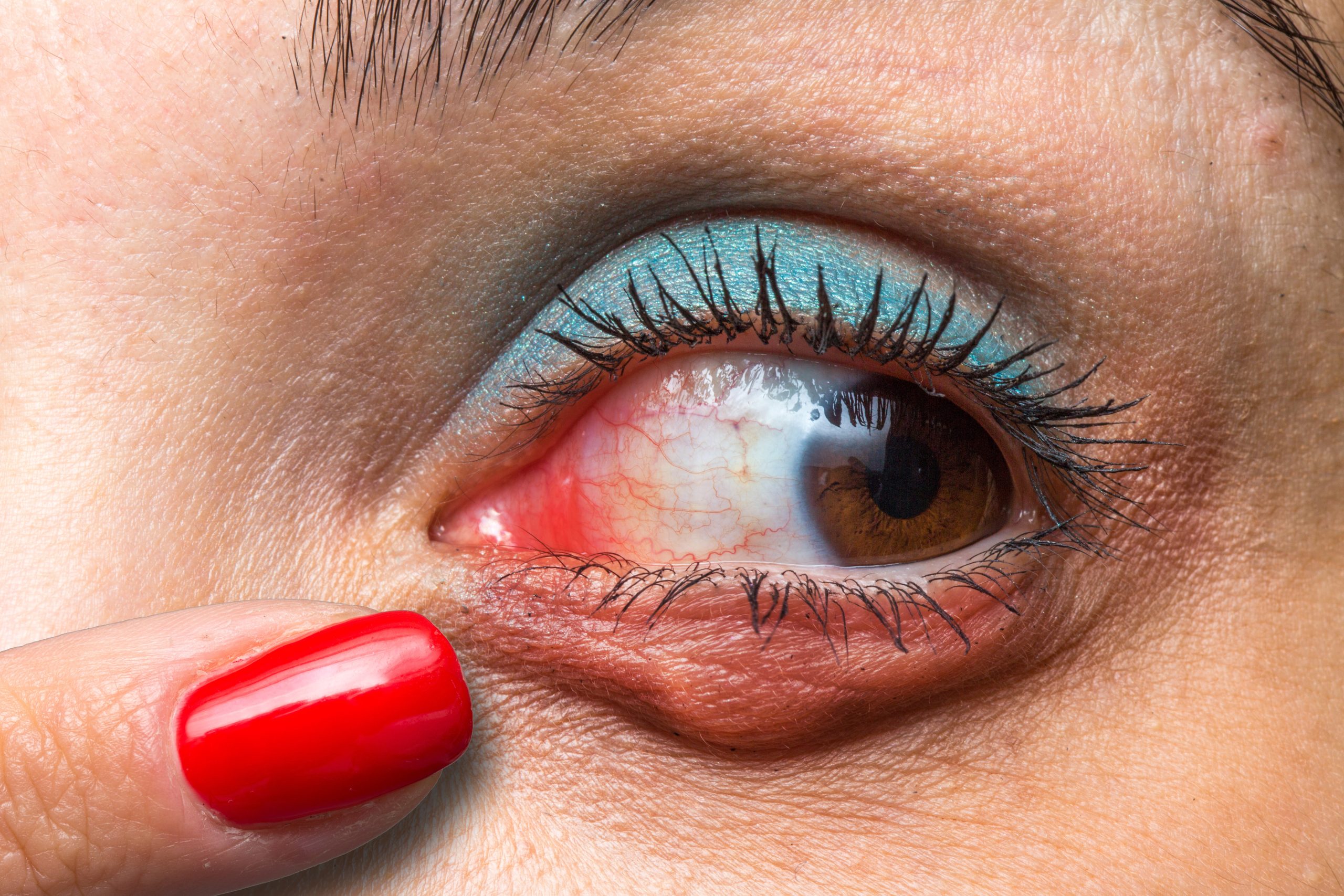 Chalazion Chronicles: Understanding the Swellings on Your Eyelids