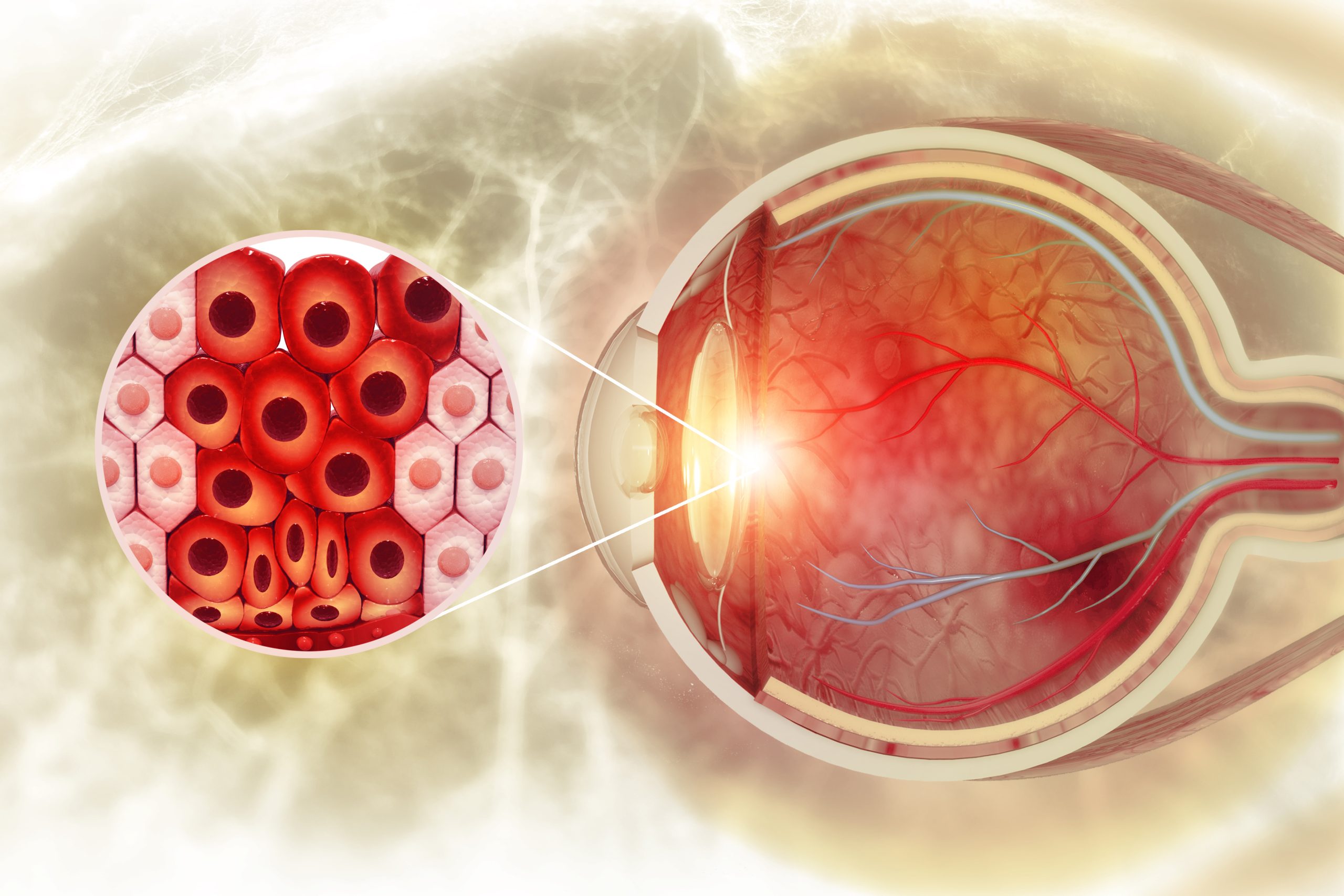 Anterior Ischemic Optic Neuropathy (AION)