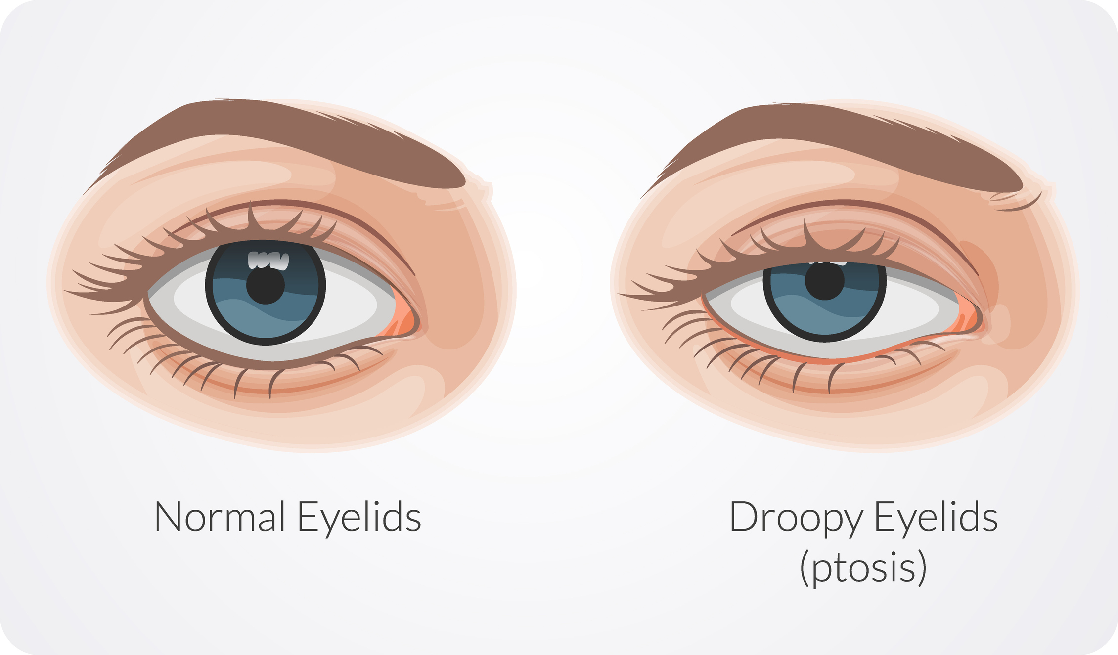 The effects of topical oxymetazoline on eyelid position, eye redness, and patient-reported eye appearance: A randomized controlled trial