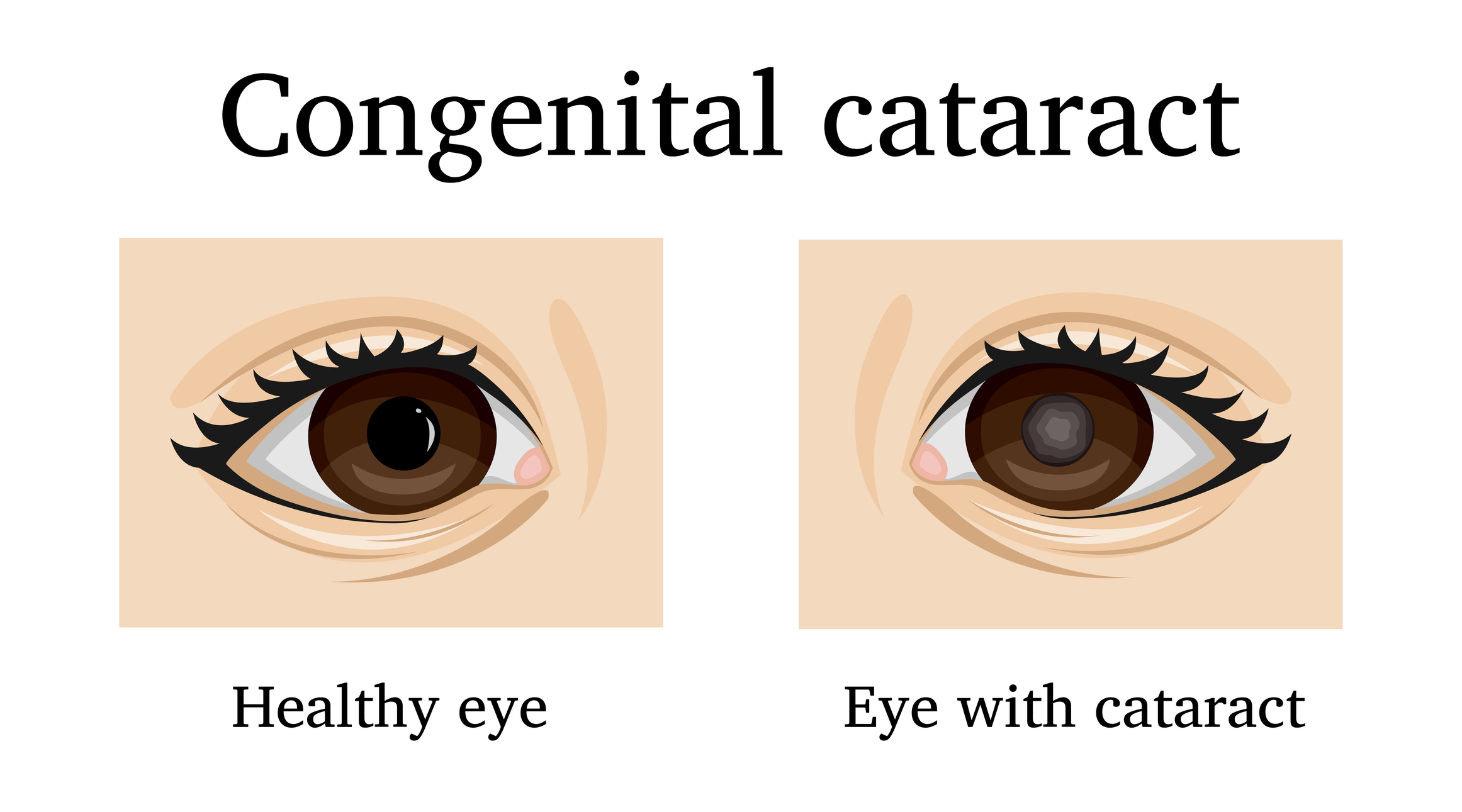 Congenital Cataracts Diagnosis and Management