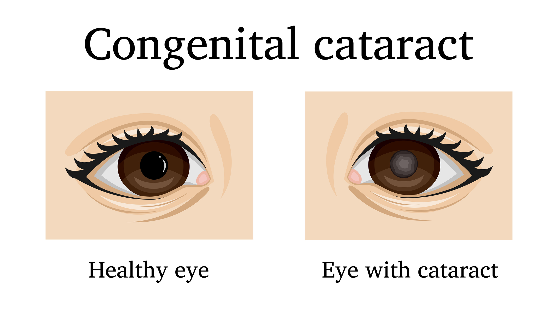 Understanding Congenital Cataracts - World Eye Care Foundation