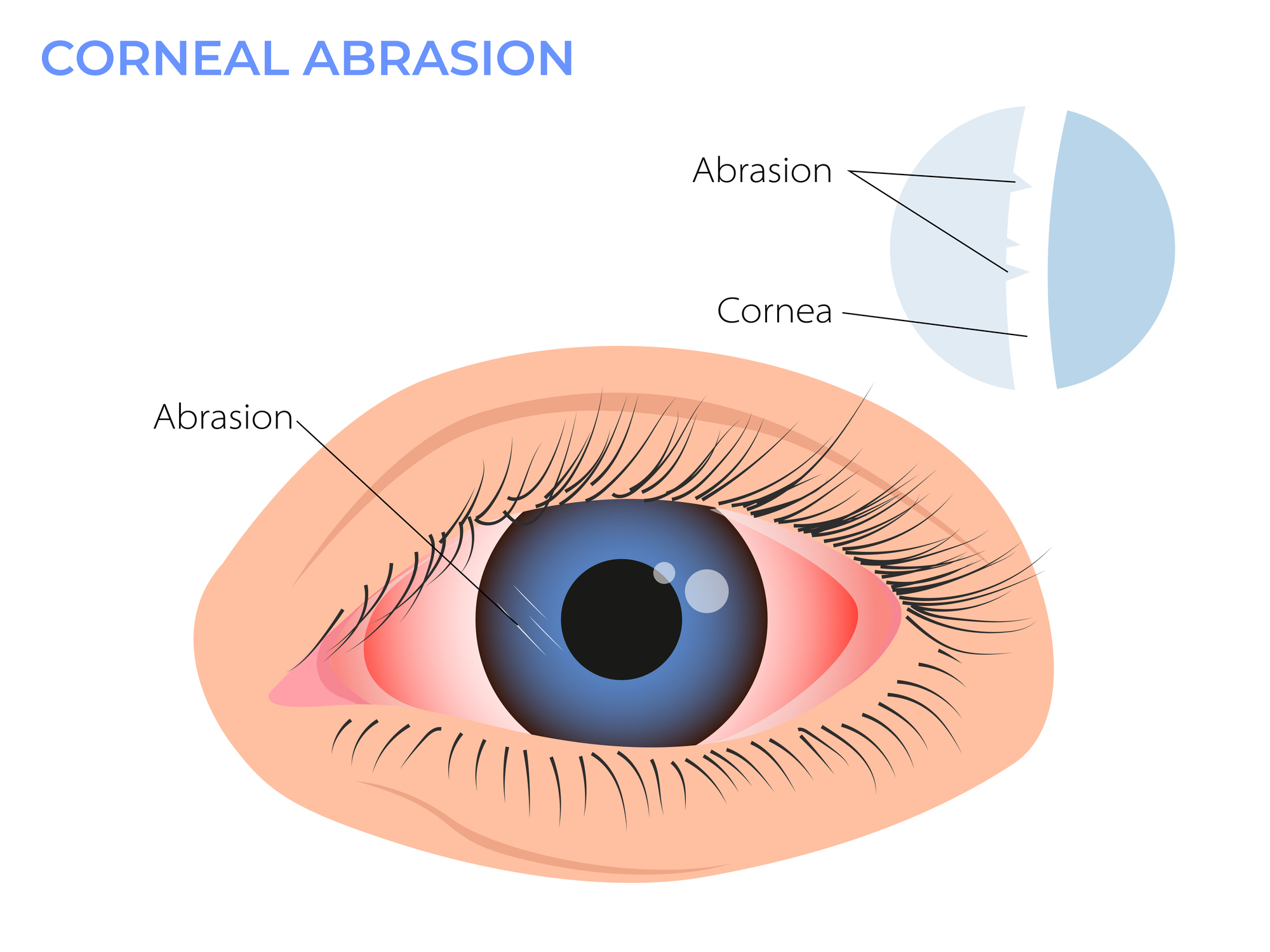 Corneal Erosion Syndrome: Causes and Treatment
