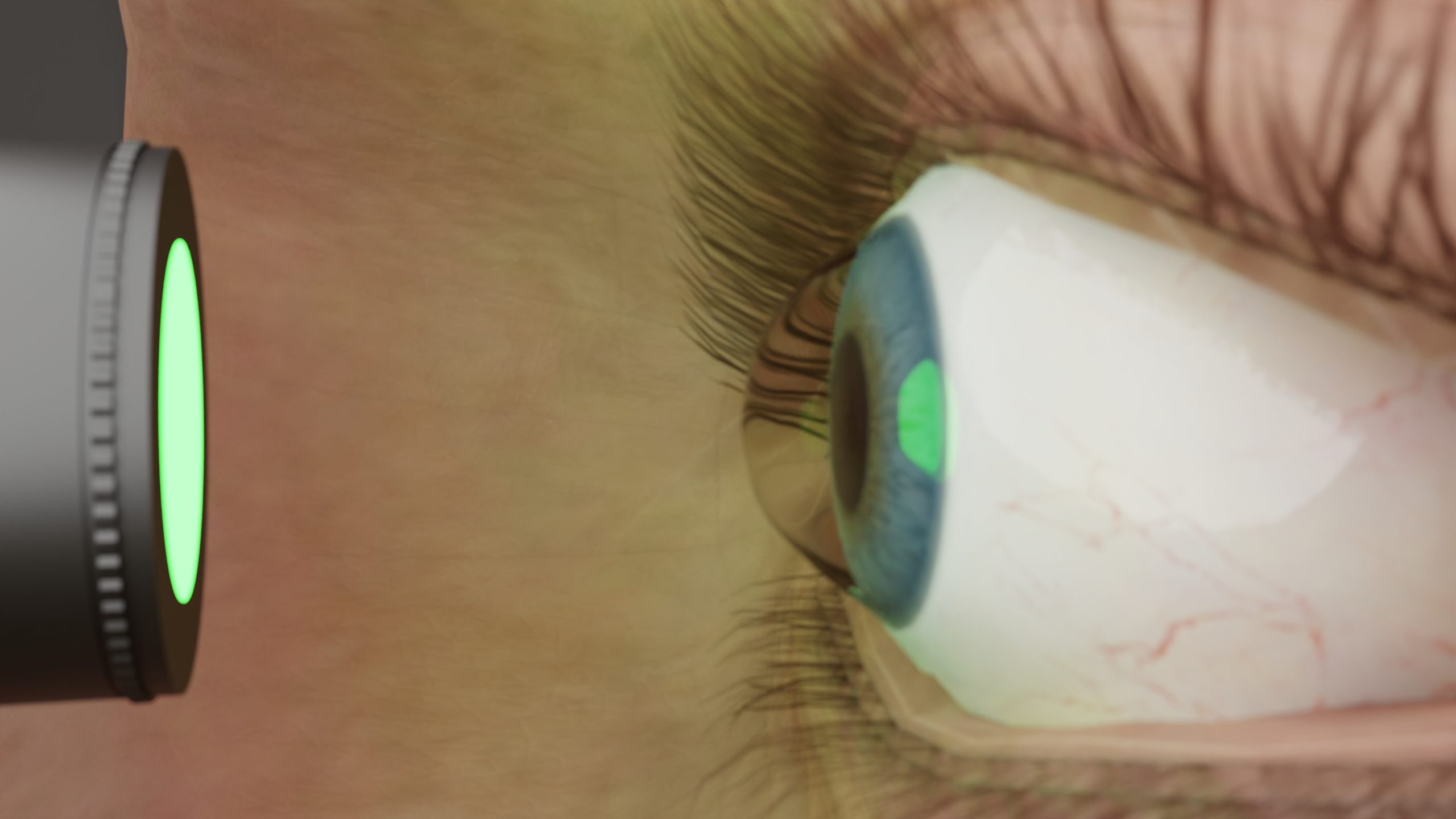 Exploring Femtosecond Laser Assisted Cataract Surgery (FLACS)