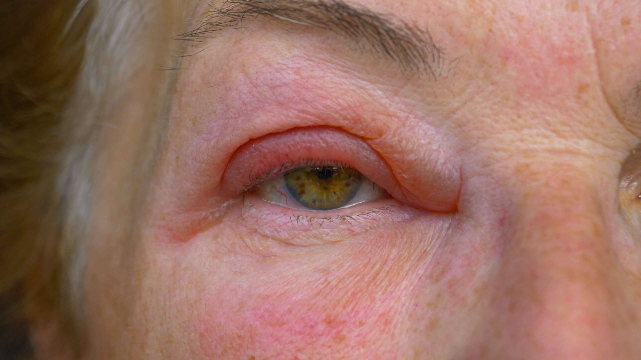 Fungal Keratitis: Symptoms and Management