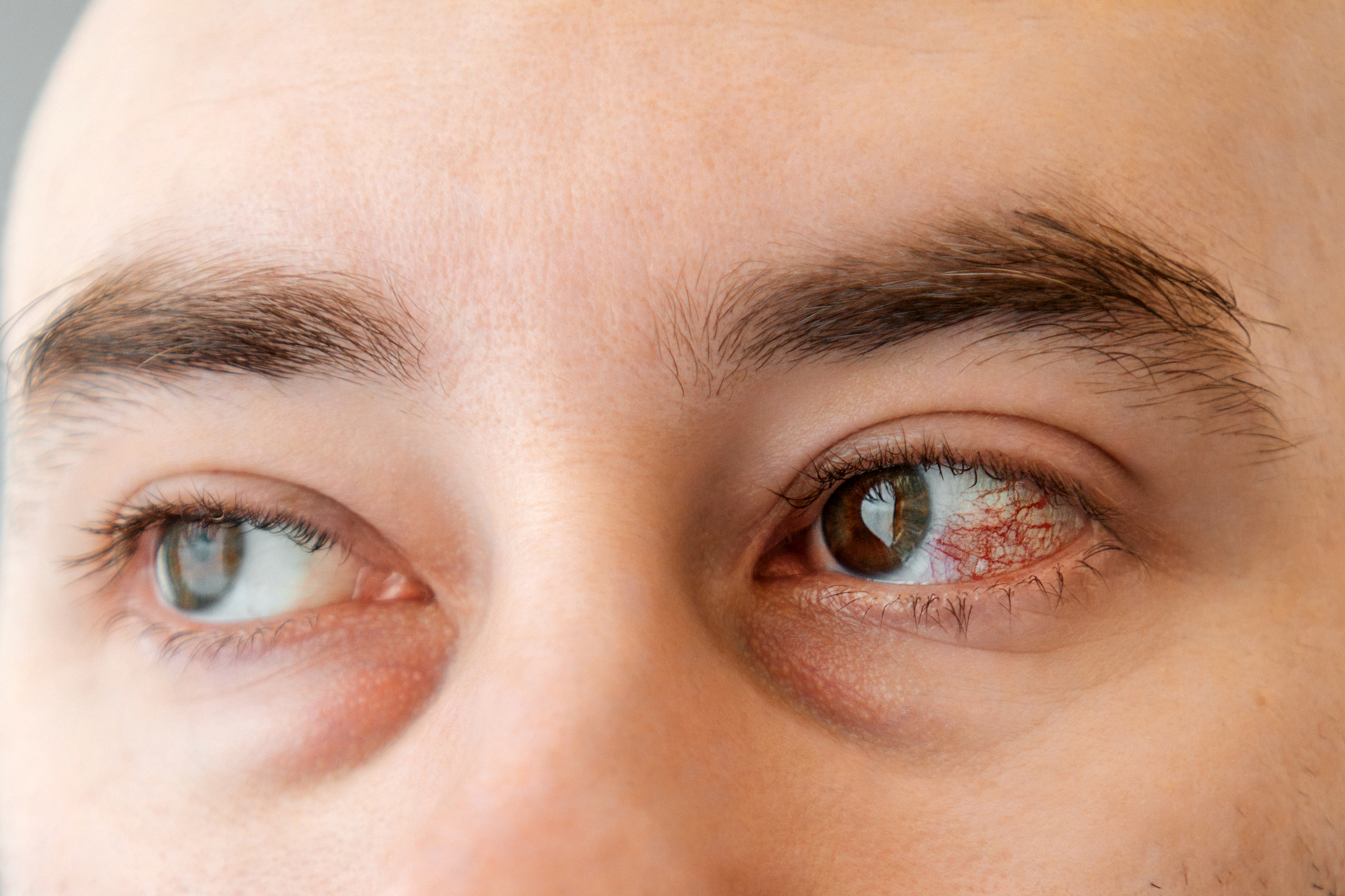 Herpes Keratitis: Causes and Management