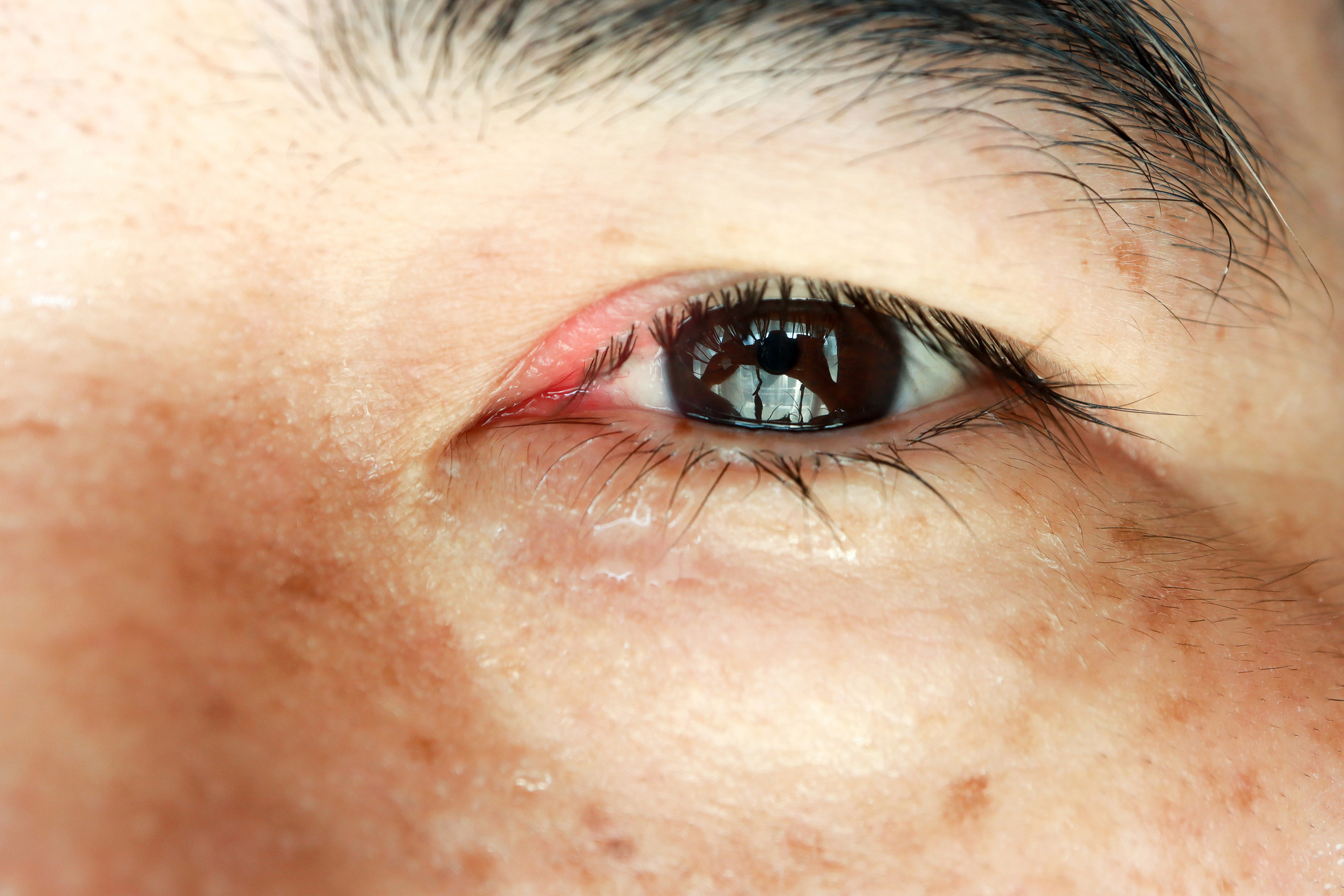 Keratoconjunctivitis Sicca: Causes and Treatment