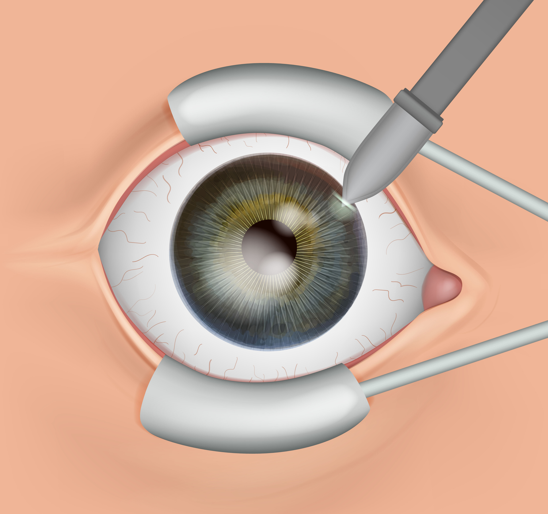 Minimally Invasive Glaucoma Surgery (MIGS)