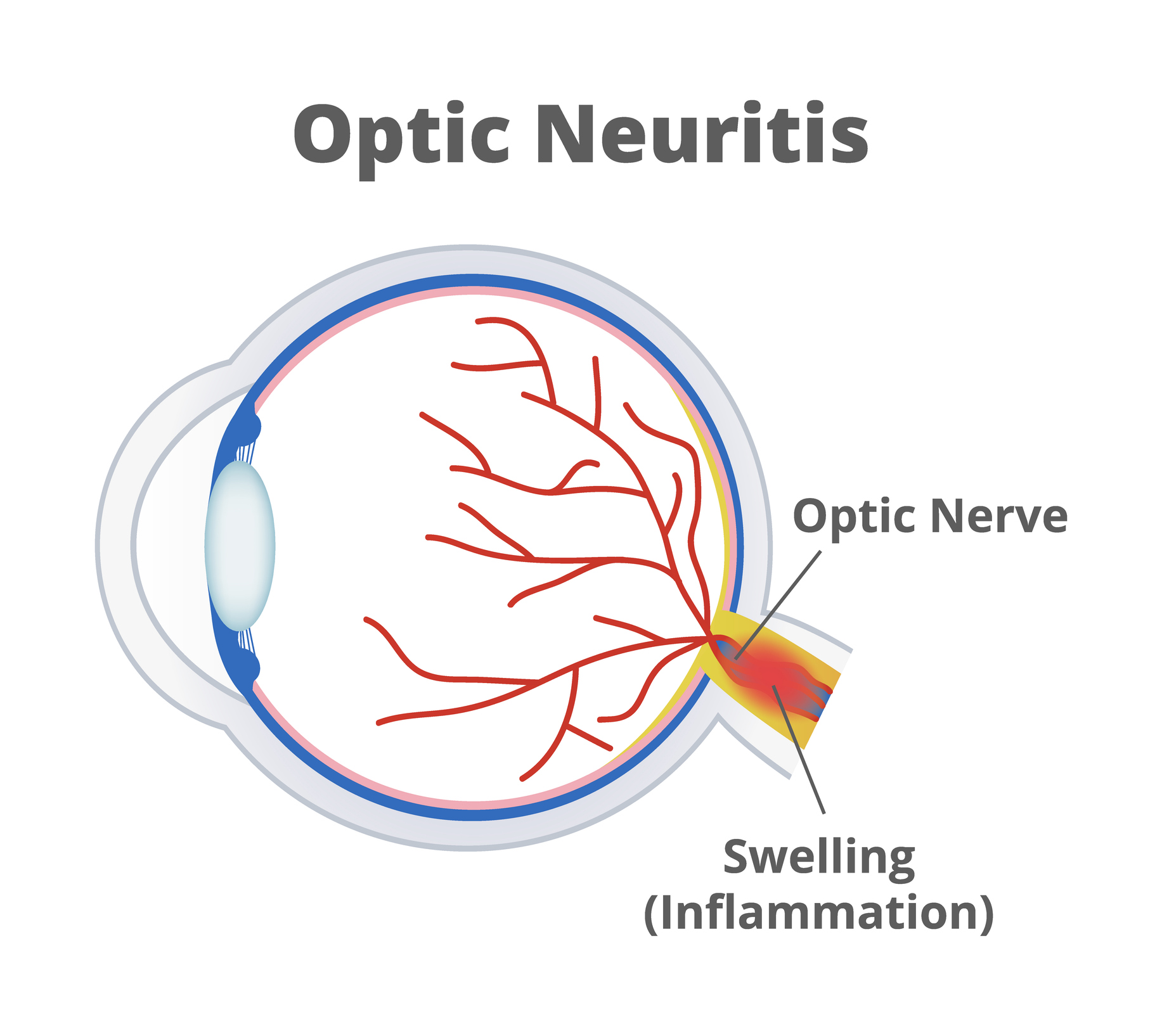 Ocular Myasthenia Gravis: Symptoms and Diagnosis
