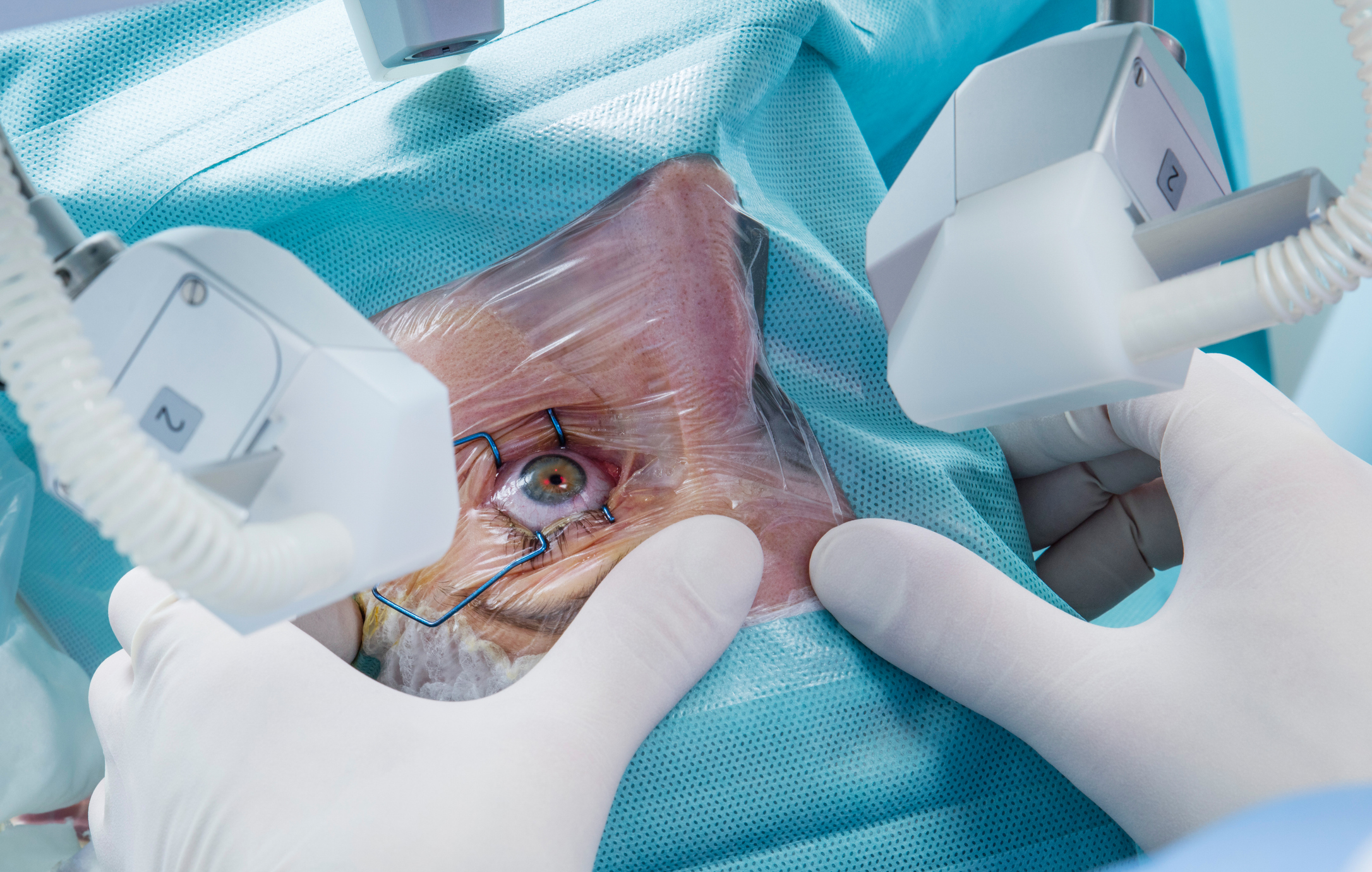 Orbital Decompression Surgery for Thyroid Eye Disease