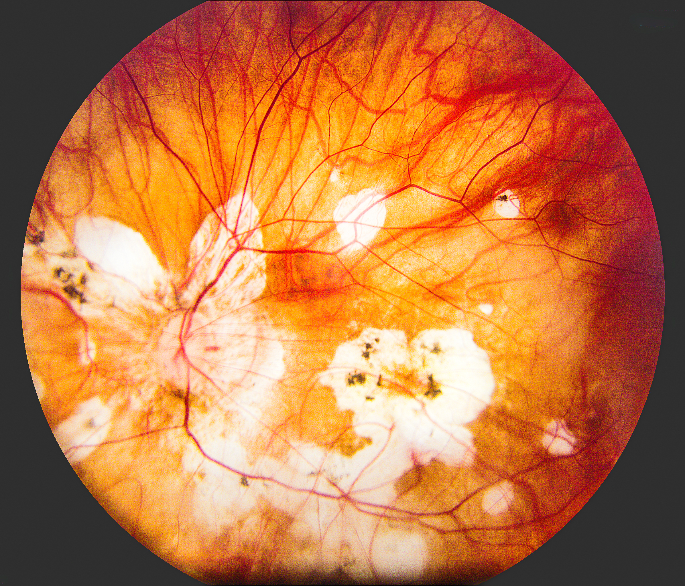 Retinal Artery Occlusion: Symptoms and Treatment