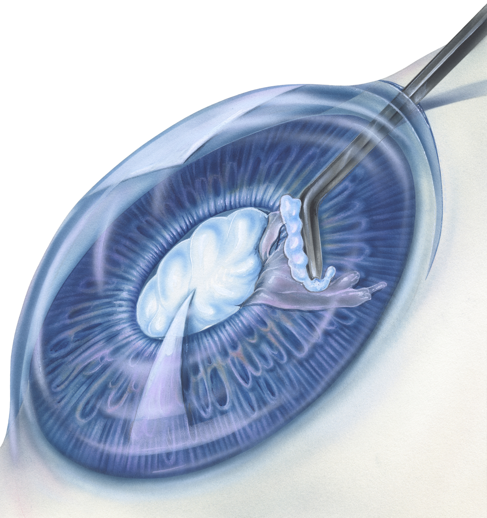 Surgical Approaches to Pterygium Removal