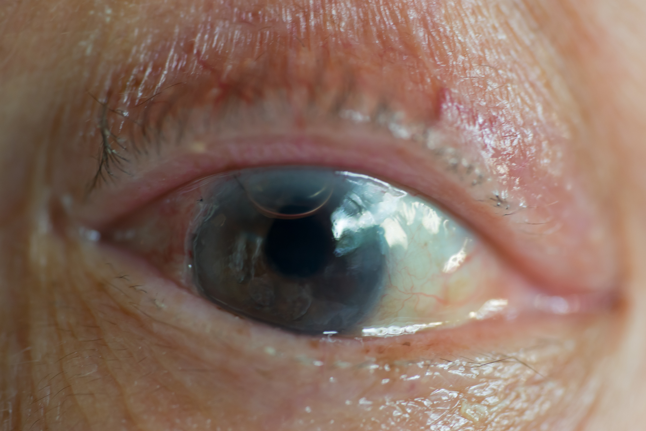 Toxocariasis: Ocular Symptoms and Treatment