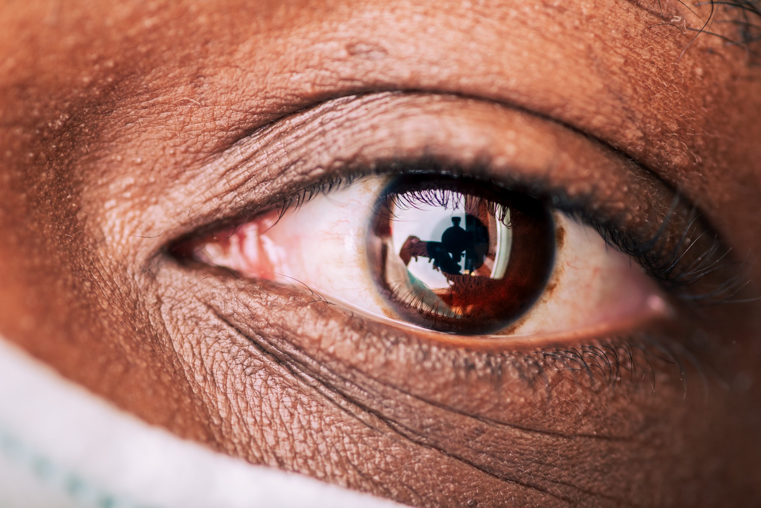 Exploring the Diverse Types of Conjunctivitis: Bacterial, Viral, Allergic, and Others
