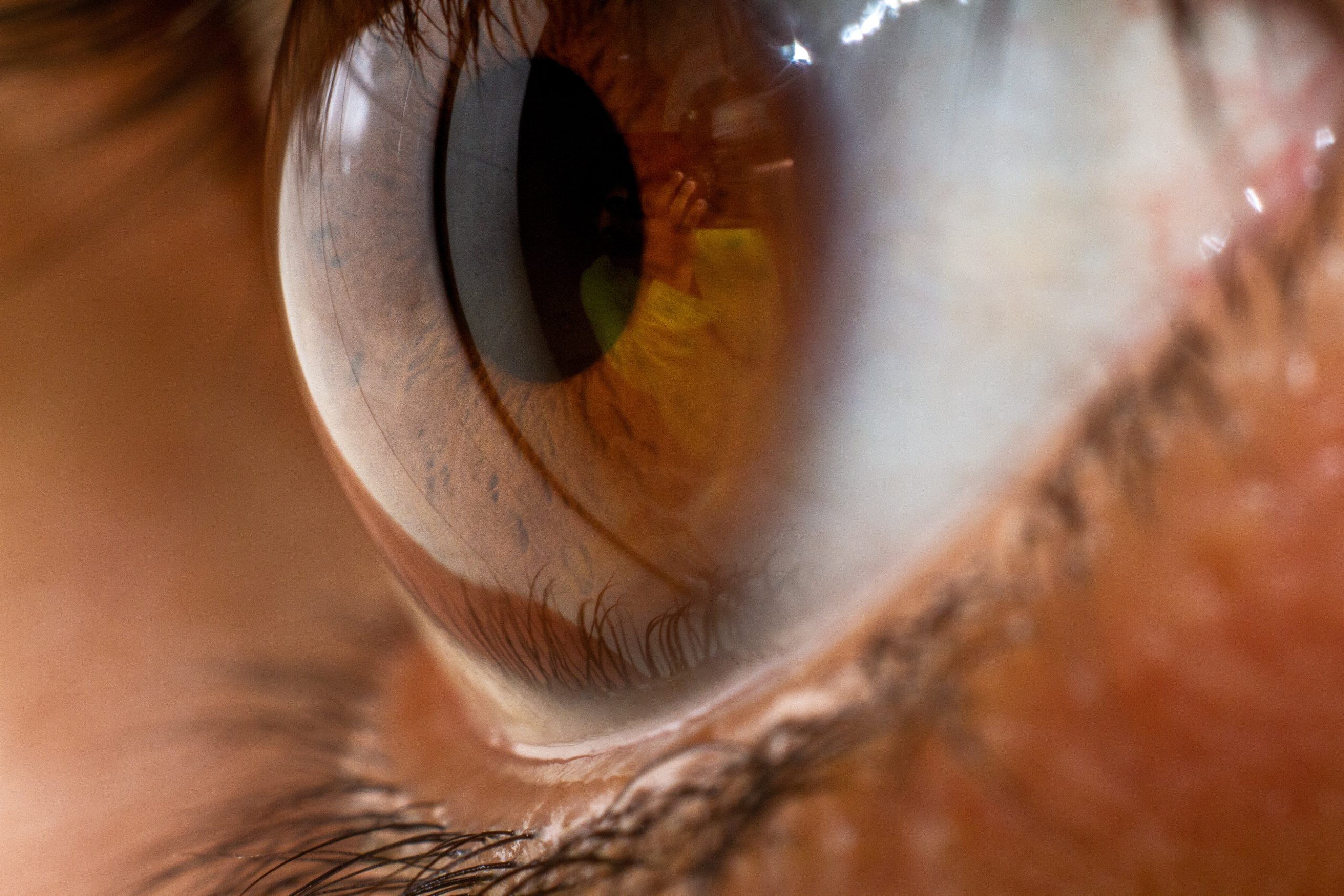 An In-Depth Exploration of Conjunctival Chemosis