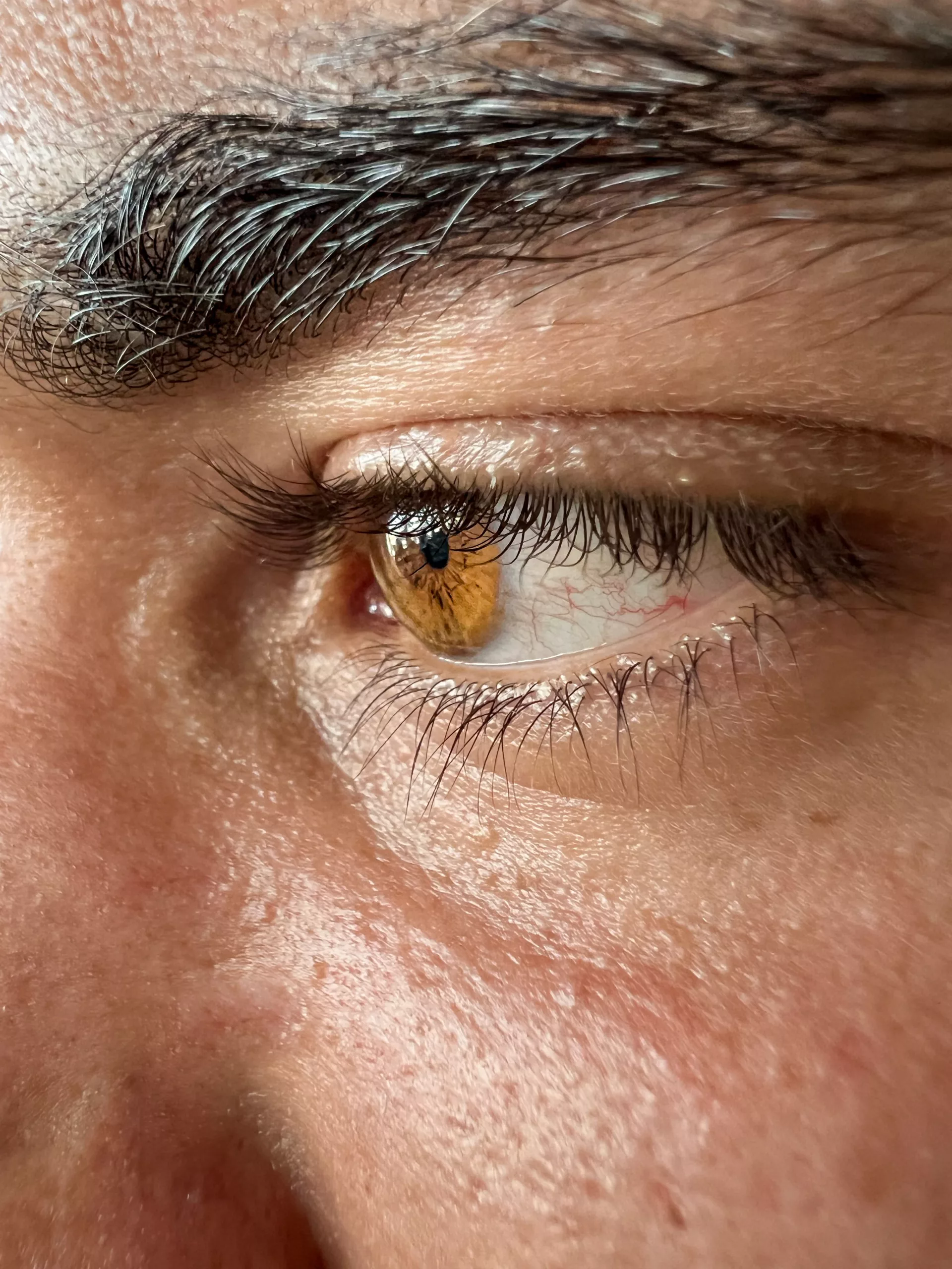 Ocular Manifestations of Scleroderma