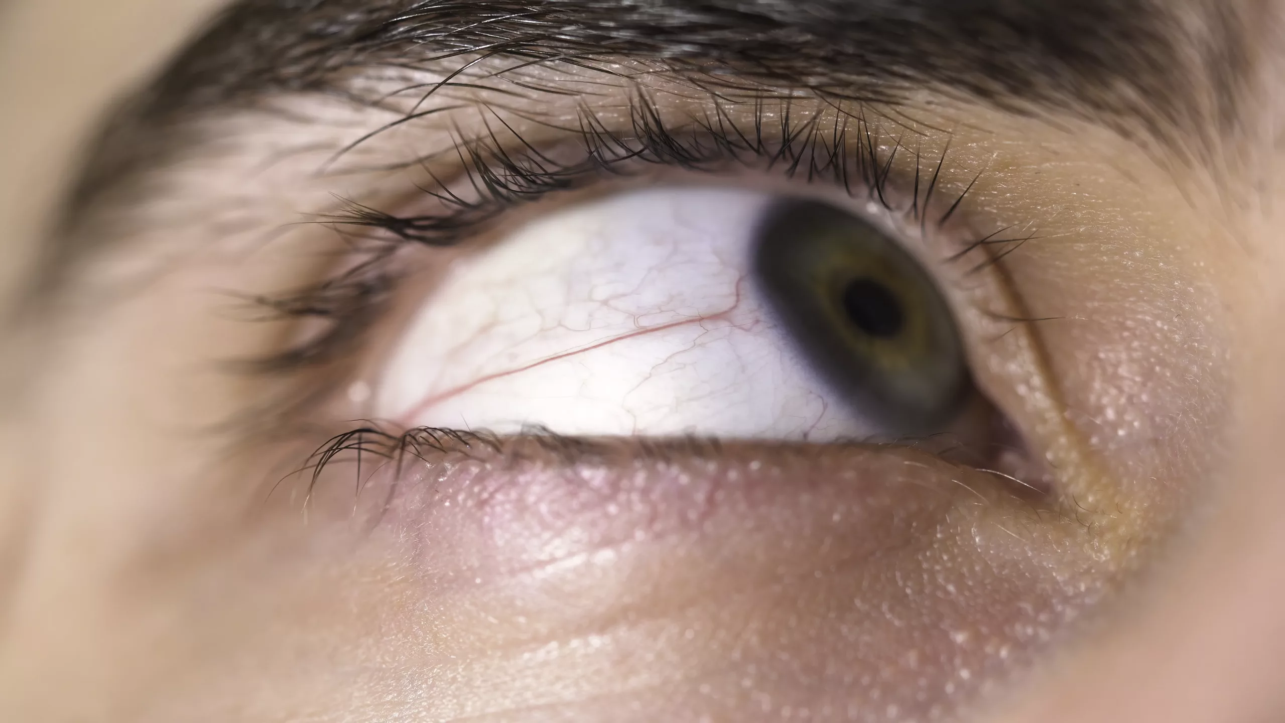 Understanding Behçet's Disease in Eyes