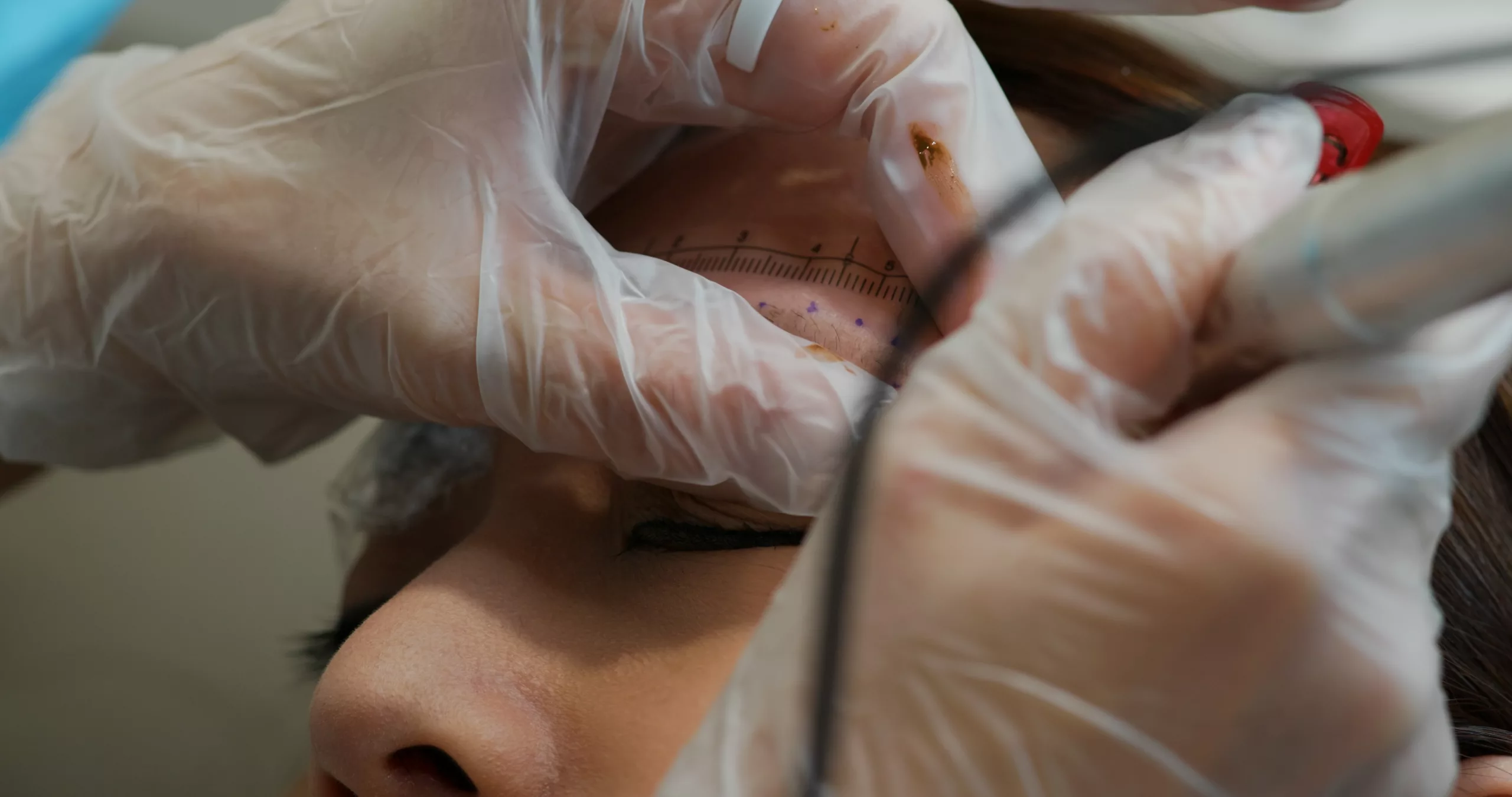 Comprehensive Guide to Prolene Sutures in Ophthalmic Surgery